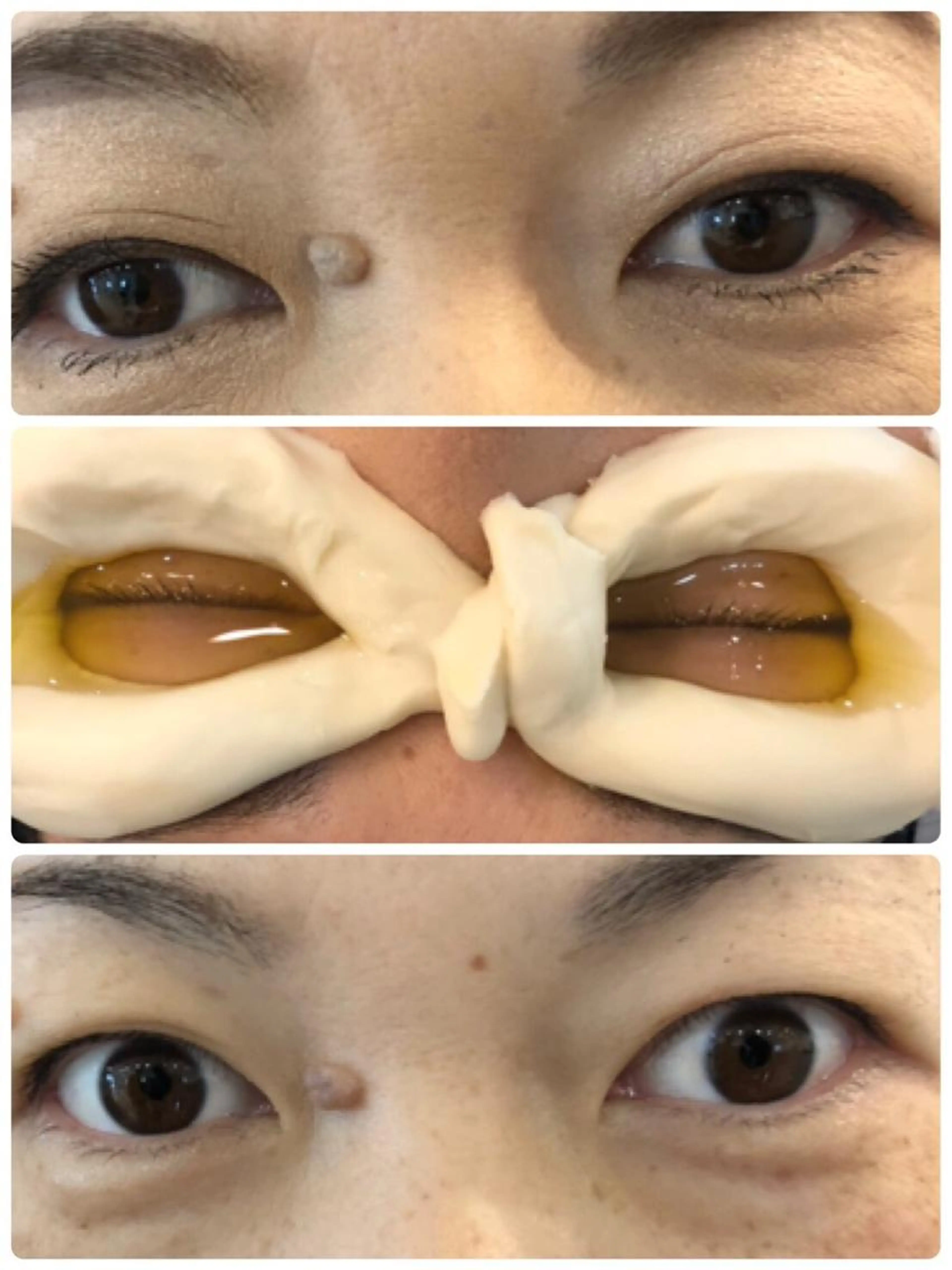 眼球エステ ネトラバスティ  眼精疲労 ドライアイ 白目クリーニングの写真