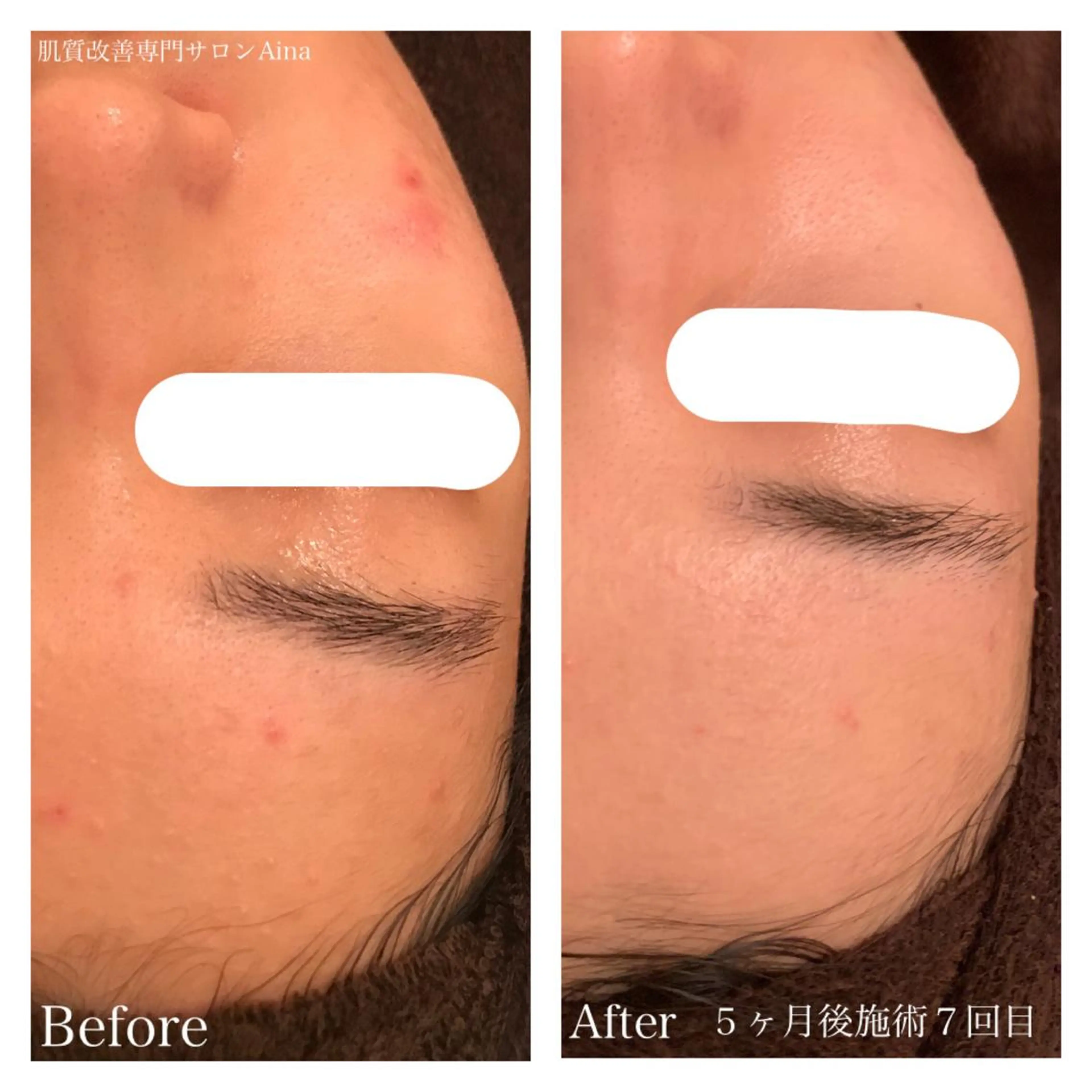 ミディアム カラー キッズ ネイル マツエク・マツパ エステ リラク ニキビ跡専門サロン Ａｉｎａのエステ・リラクイメージ