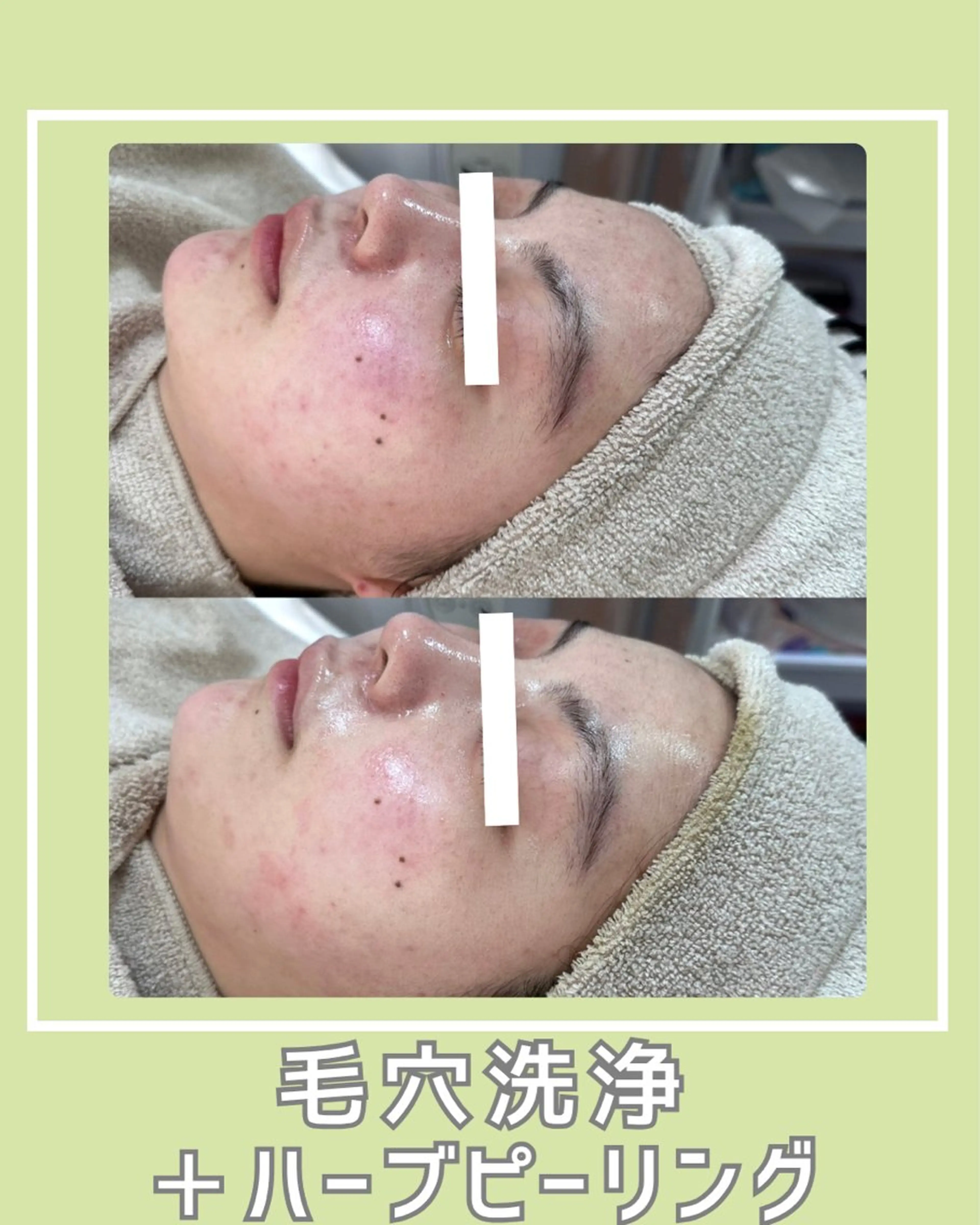 エステ |ピーリング・毛穴| soina神楽坂のエステ・リラクイメージ