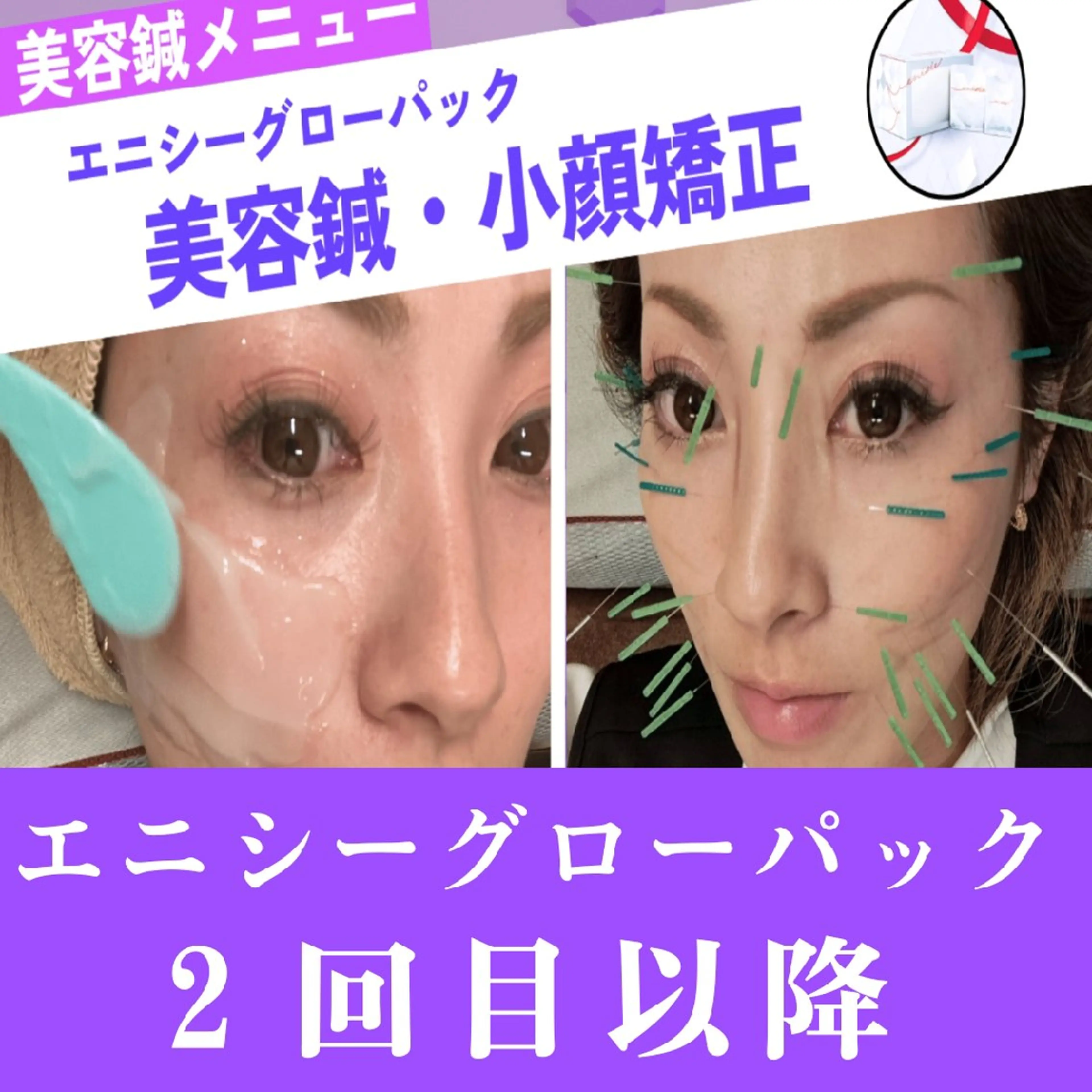 エニシーグローパック＋美容鍼＋小顔矯正　 2回目以降の写真