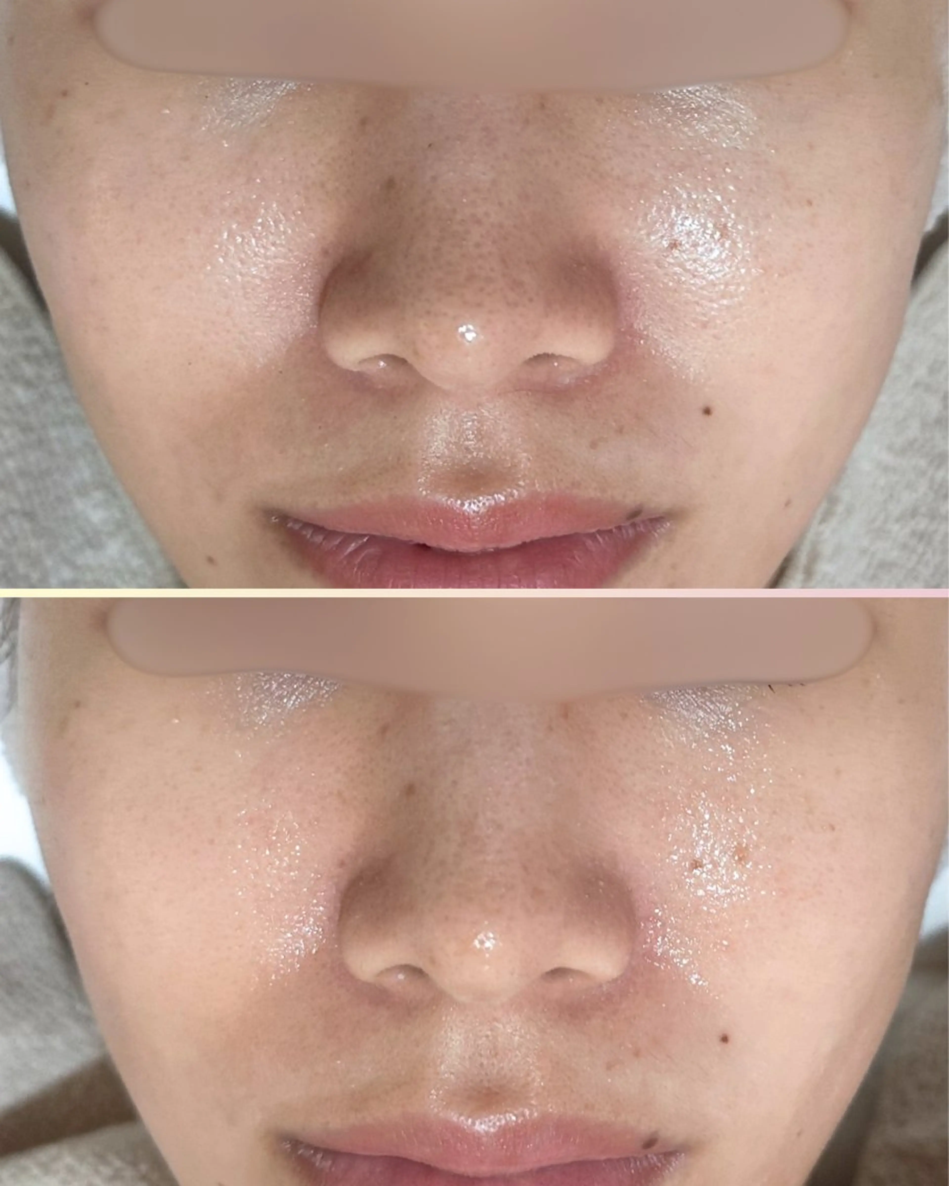 エステ |ピーリング・毛穴| soina神楽坂のエステ・リラクイメージ