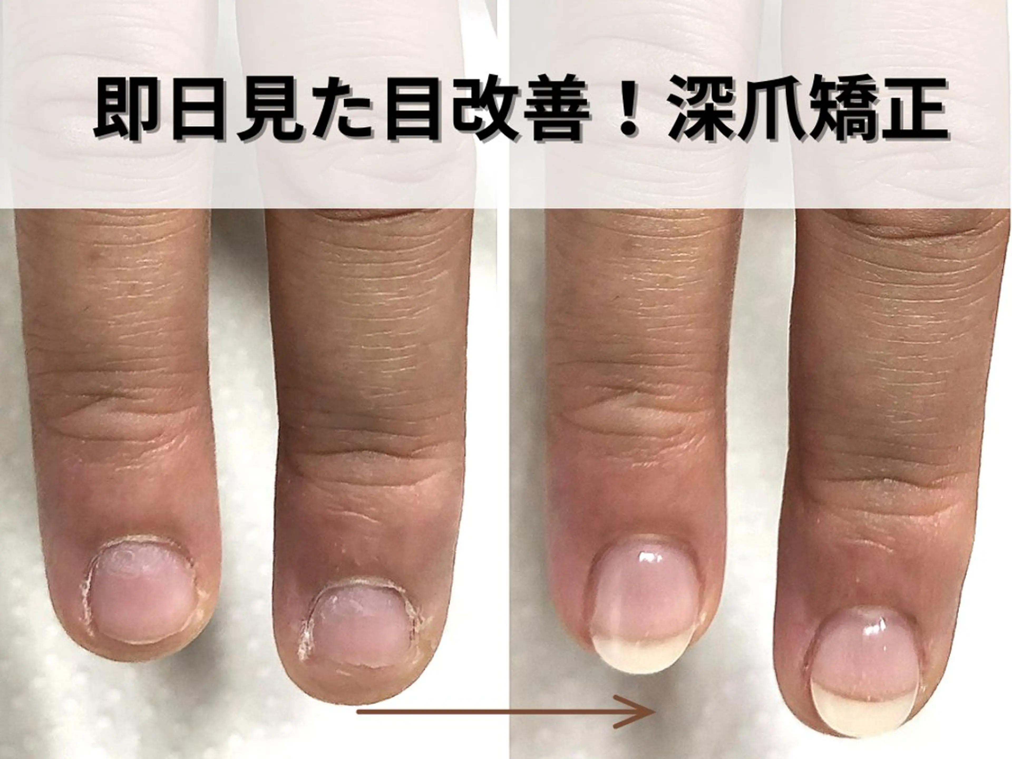 長年悩んでいた深爪も、即日見た目改善！深爪の方のみお受けできます。ベテランスタッフによる、深爪矯正メニューの練習モデルの写真
