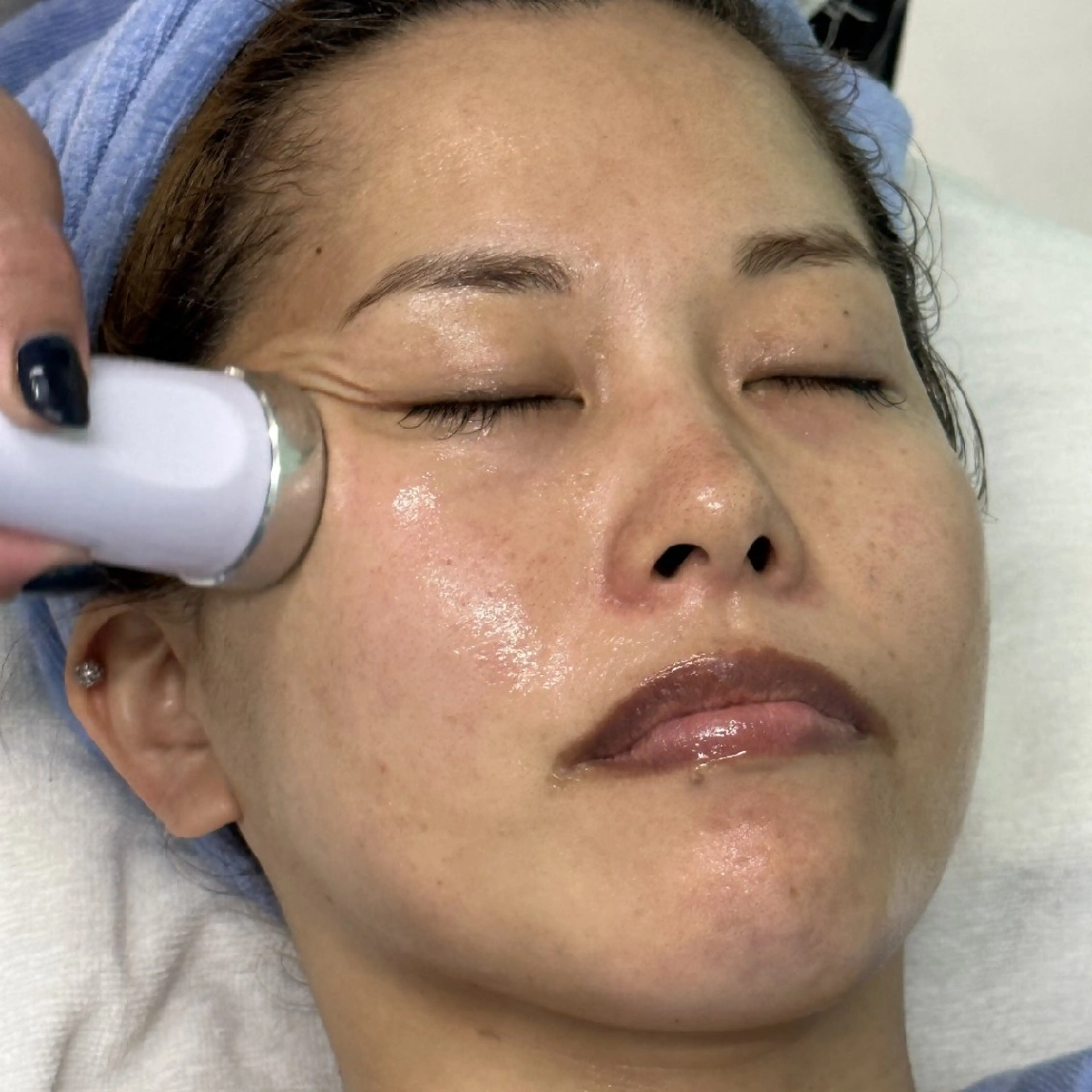 ※高周波コース(約60分) ニキビ・シワ・たるみ・ハリ・くすみケアの写真