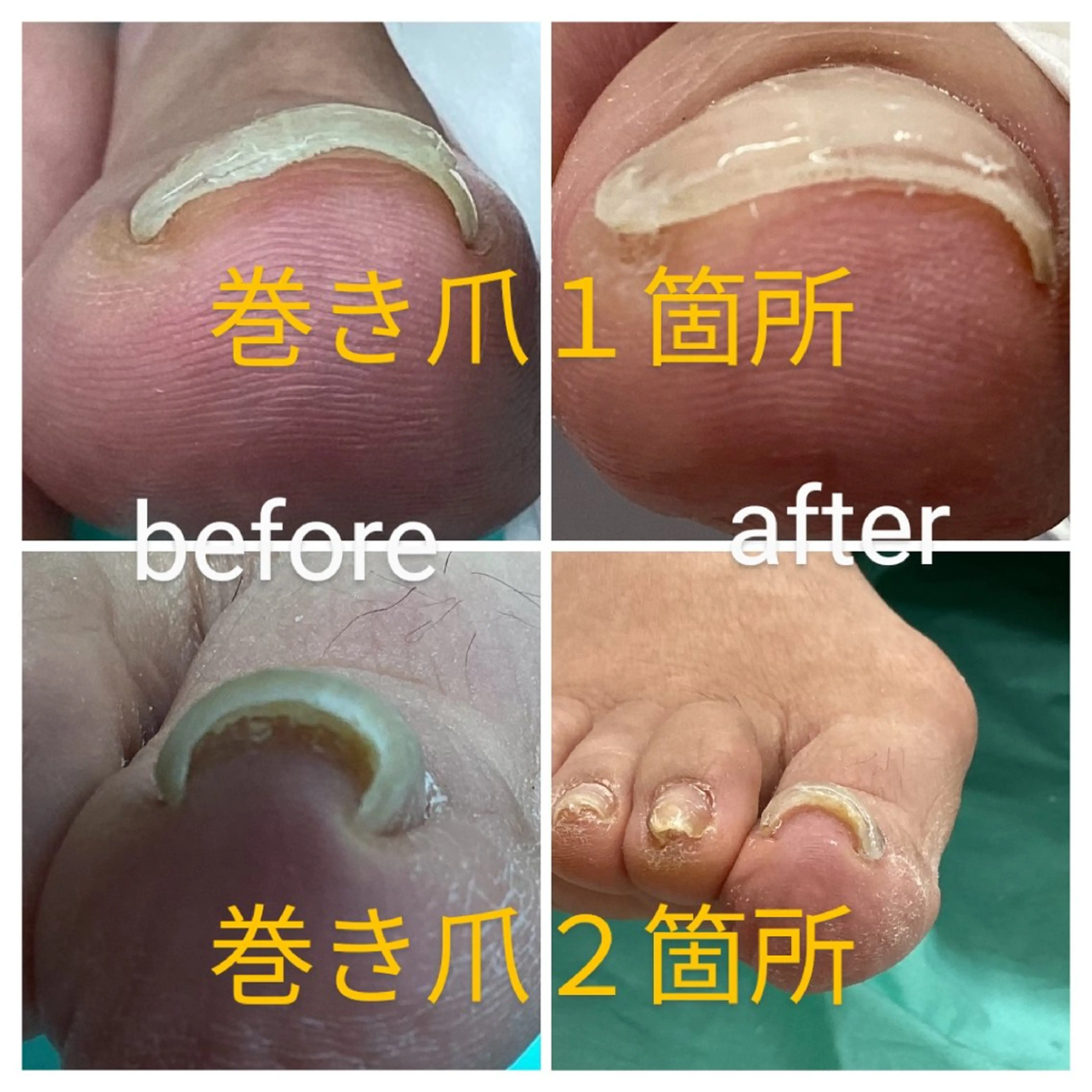 巻き爪補正店 大阪なんば店のネイルデザイン