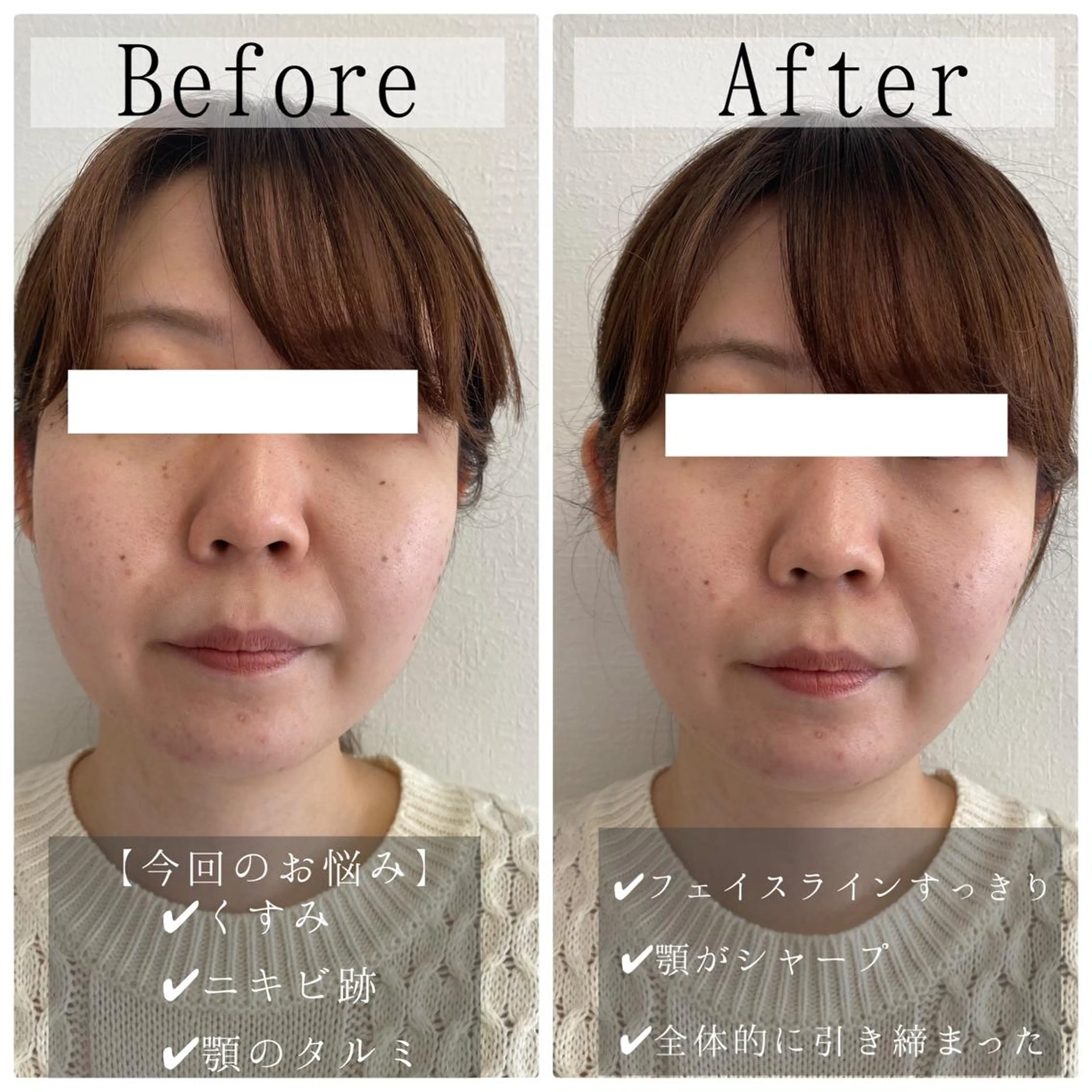 ニキビ特化美容鍼 ×ハーブピーリングのエステ・リラクイメージ