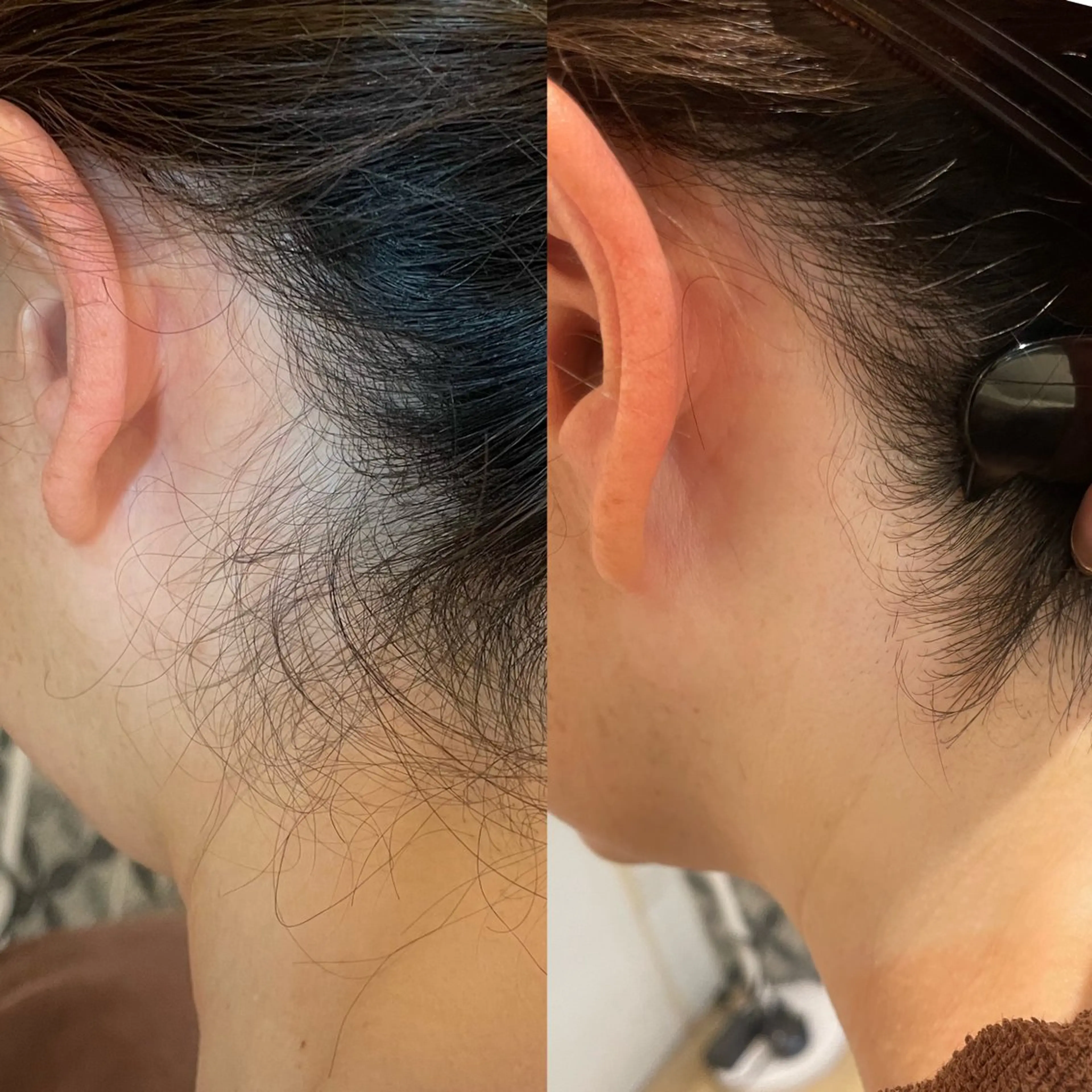 美肌シェービング（顔•首•うなじ３箇所）¥3,500の写真