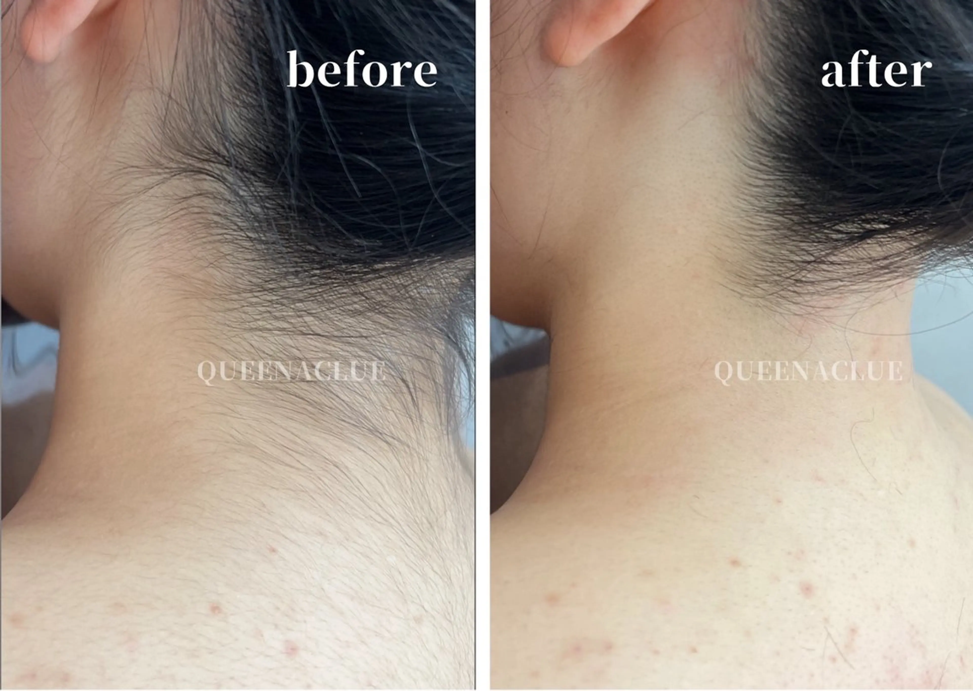 脱毛 毛穴改善/脱毛 ネイル　川上久仁子のエステ・リラクイメージ