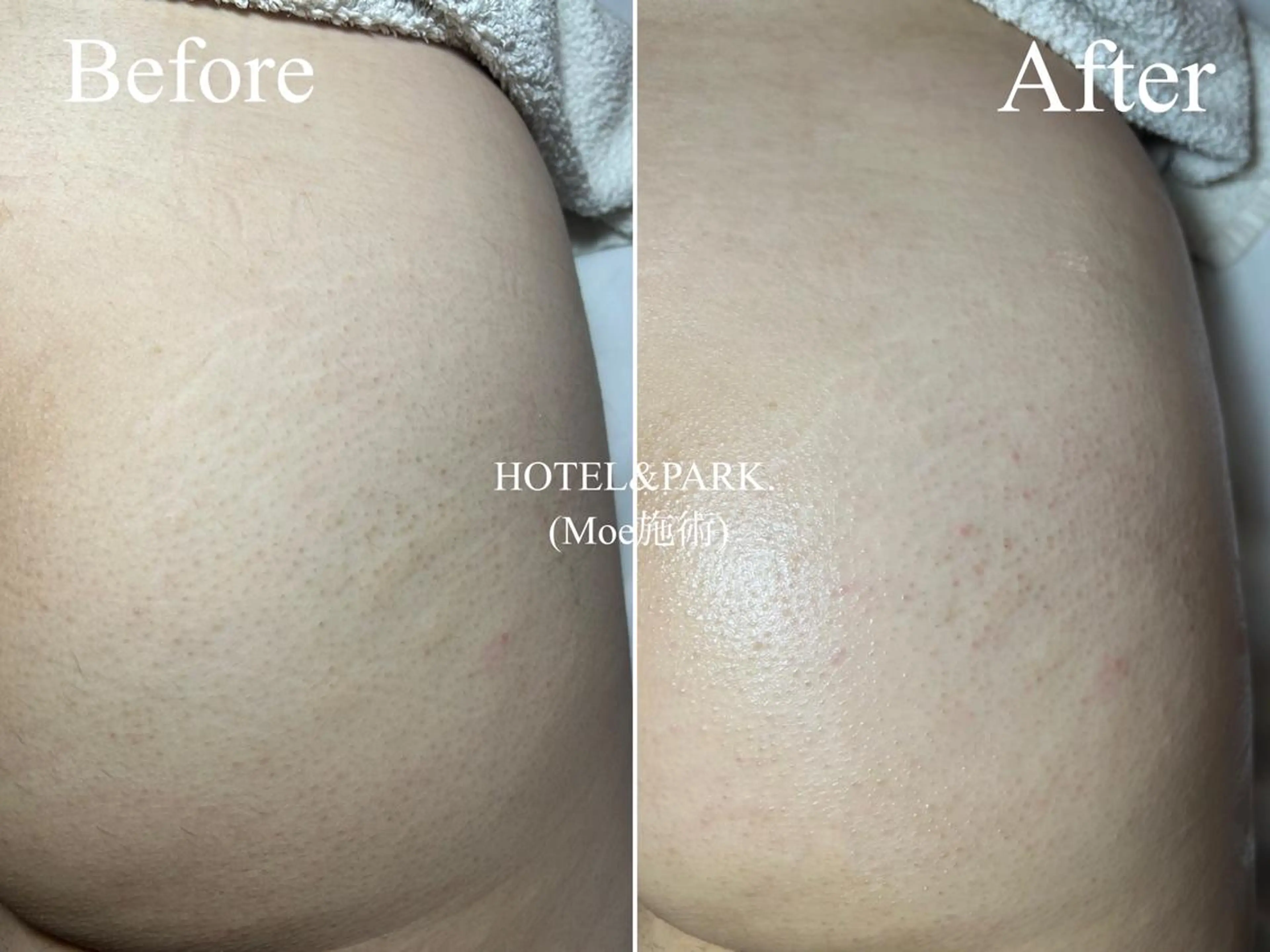 HOTEL&PARK . ワックス脱毛のエステ・リラクイメージ