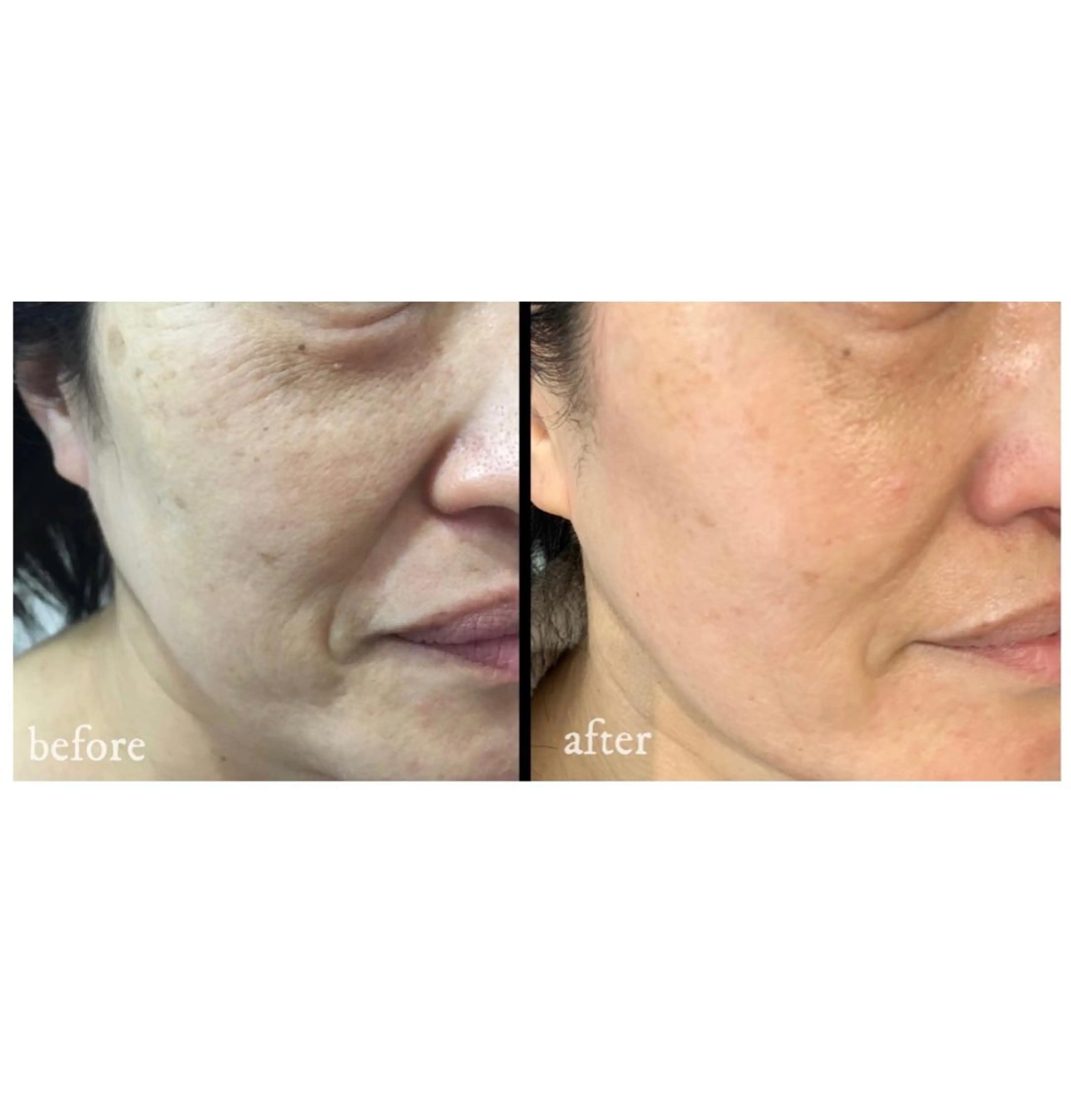 お肌を土台から元気に【光フェイシャル＋顔脱毛】１回　￥5500の写真