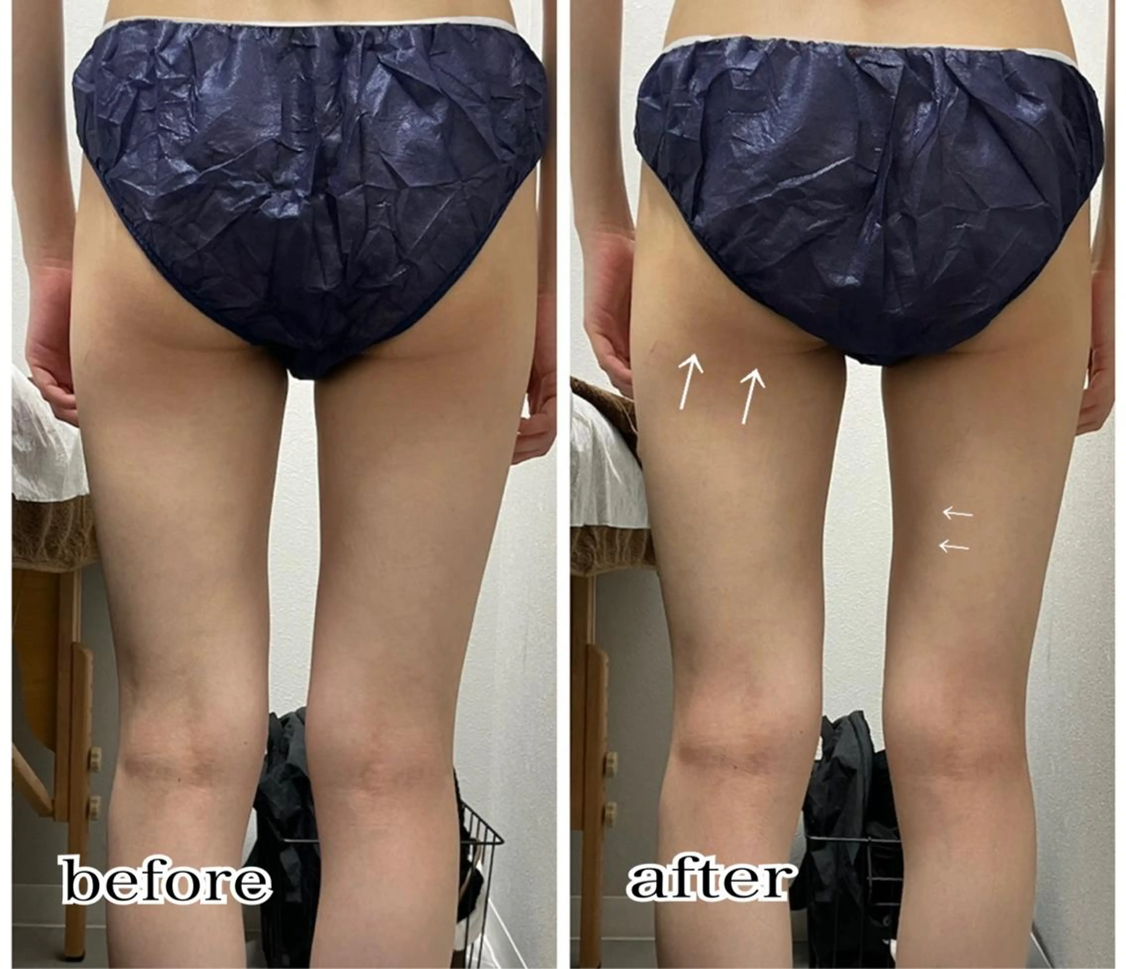 【お尻、太もも即痩せ】🌿🤍3D超音波リフト.10000shotレディースメンズok👌❤️の写真