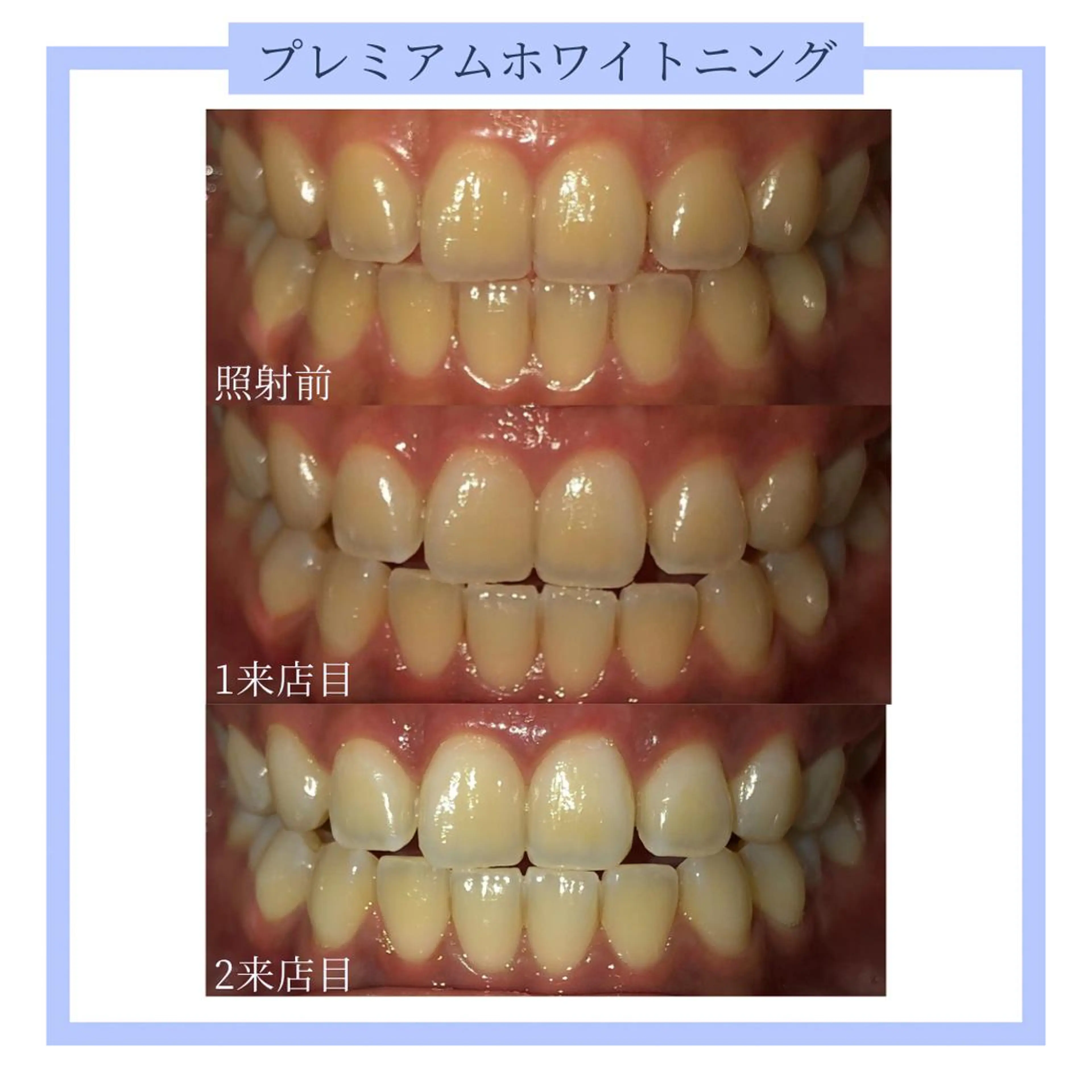 ホワイトニング|韓国式3D毛穴洗浄 lonhana ロンハナ所属・韓国式3D毛穴洗浄 lonhanaのその他イメージ