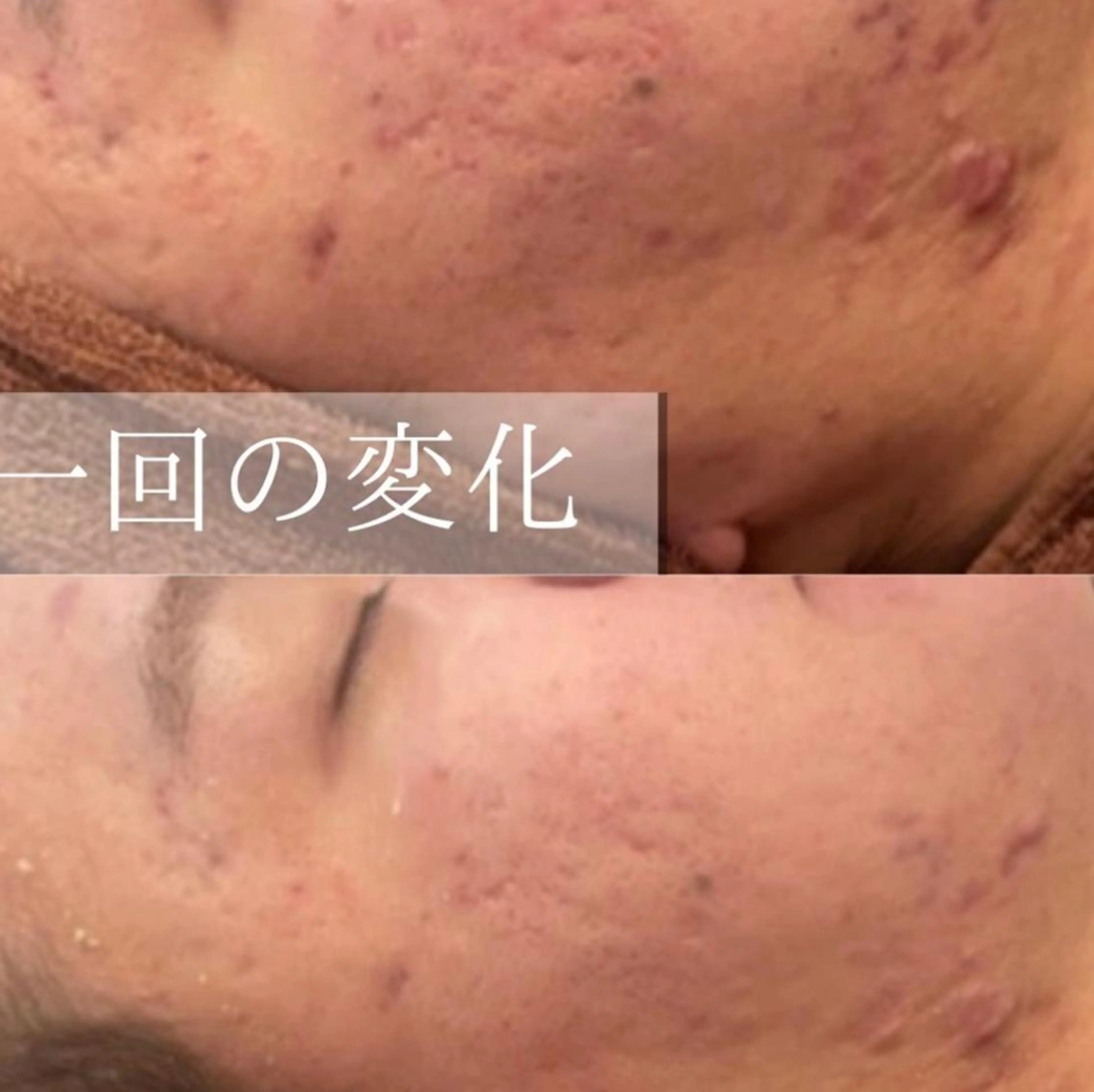 セミロング カラー パーマ ヘアアレンジ メンズ キッズ ネイル マツエク・マツパ アイブロウ 🔥3か月で肌革命 🔥ニキビ専門店のエステ・リラクイメージ