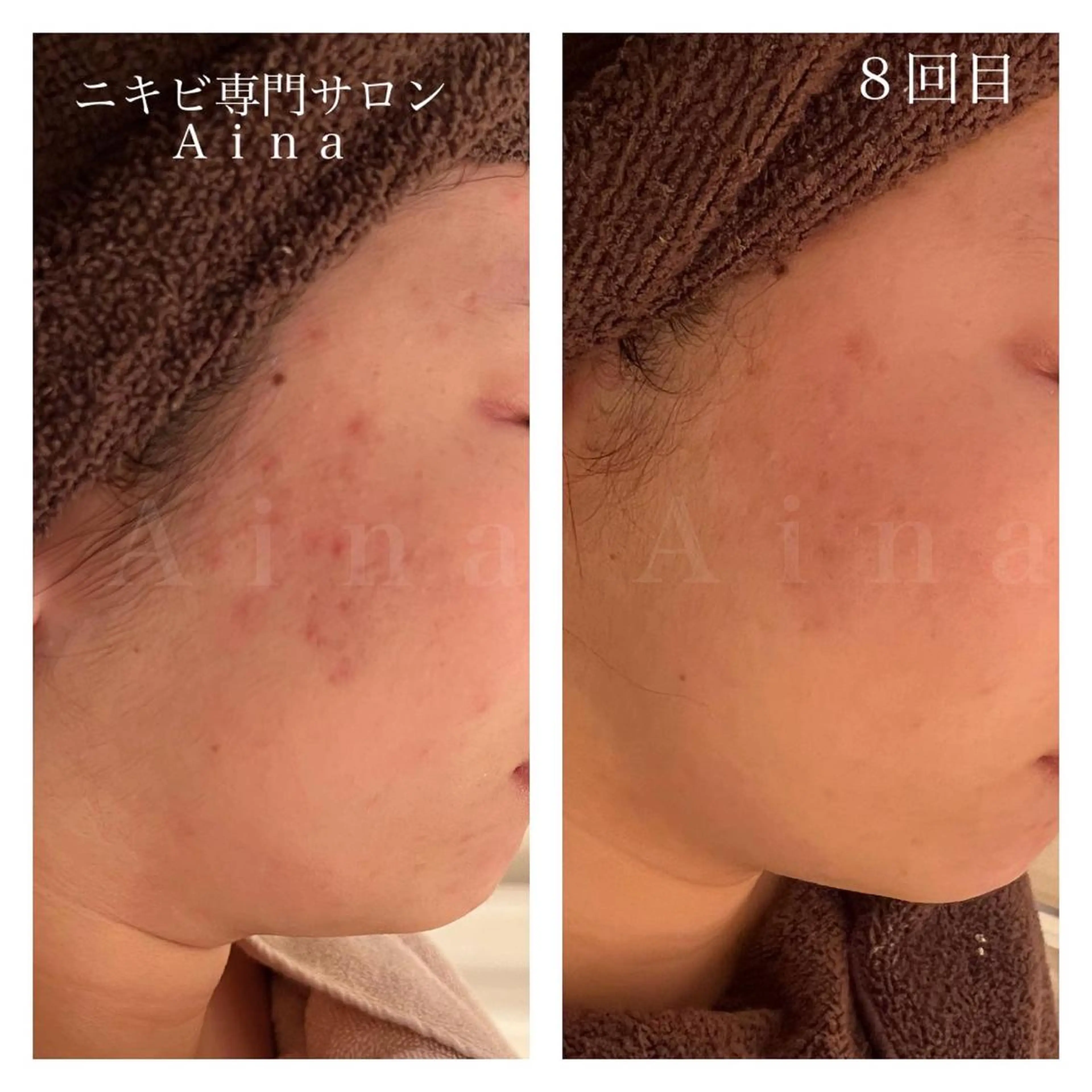 セミロング カラー パーマ ヘアアレンジ メンズ キッズ ネイル マツエク・マツパ アイブロウ 赤色 ニキビ跡専門サロン Ａｉｎａのエステ・リラクイメージ