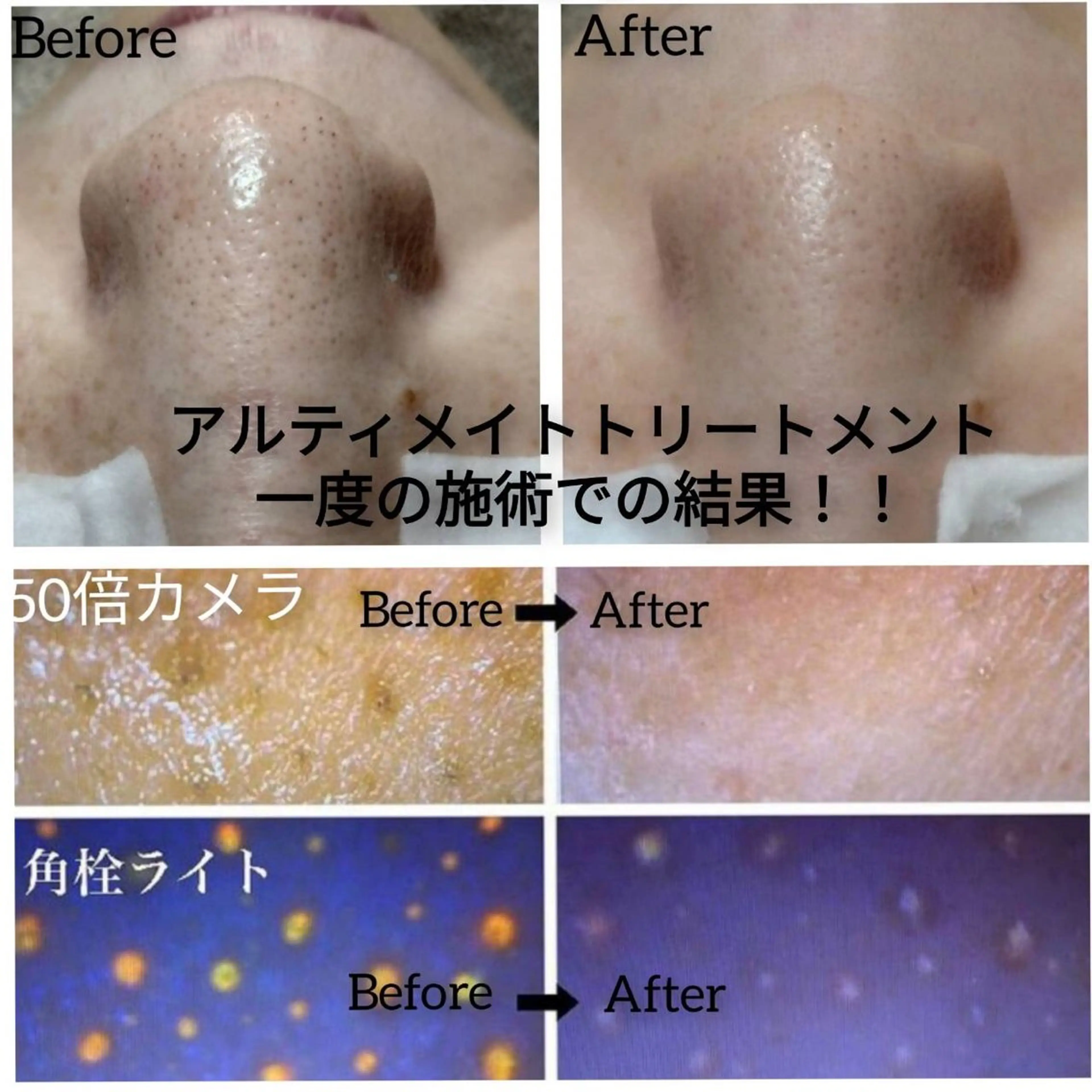 頑固な黒ずみ撃退‼️徹底毛穴洗浄毛穴レスアルティメイトコース🌟黒ずみ　ニキビ　ニキビ跡　毛穴縮小⭕️全顔水素吸引付‼️の写真