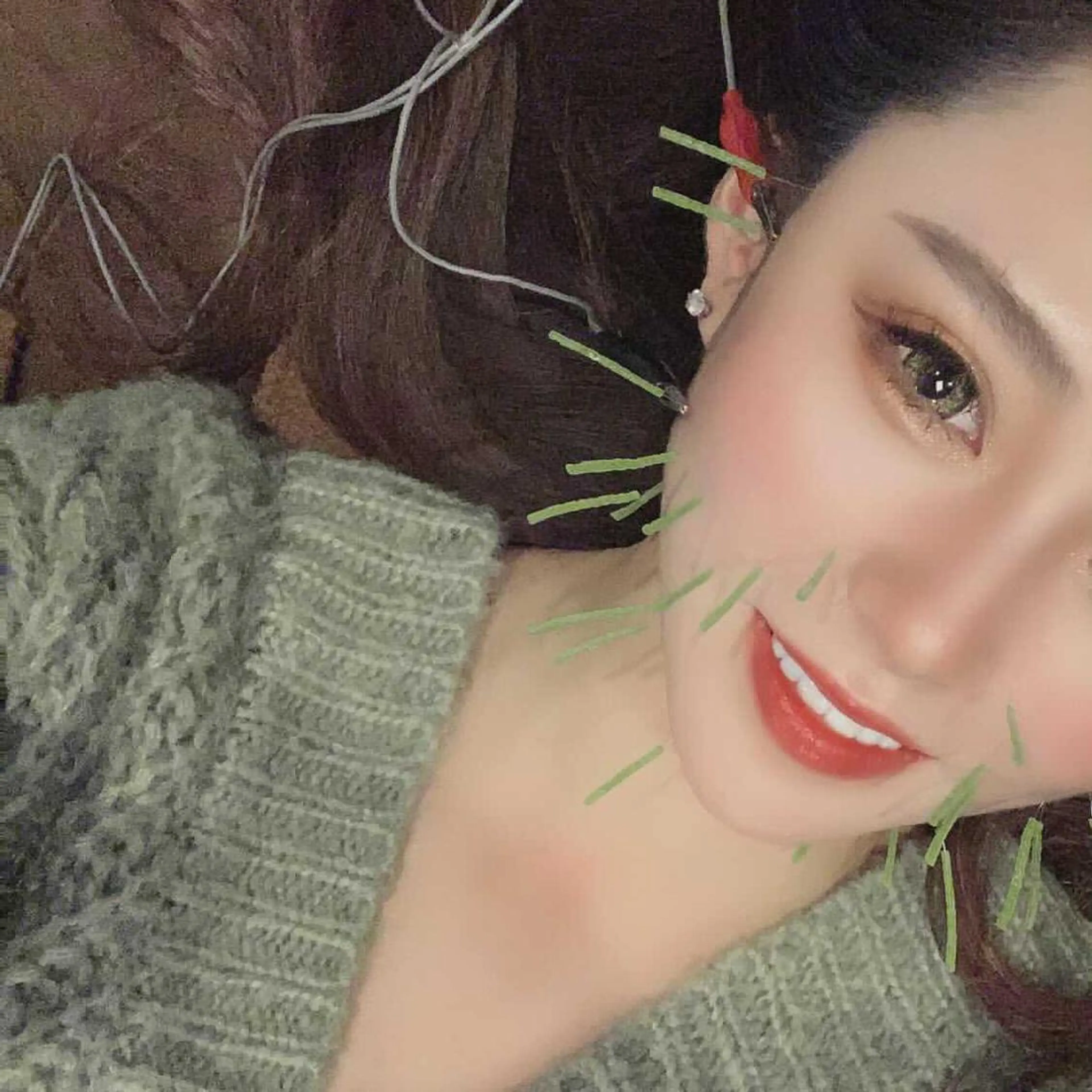 美容鍼掲載モデル価格‼️の写真