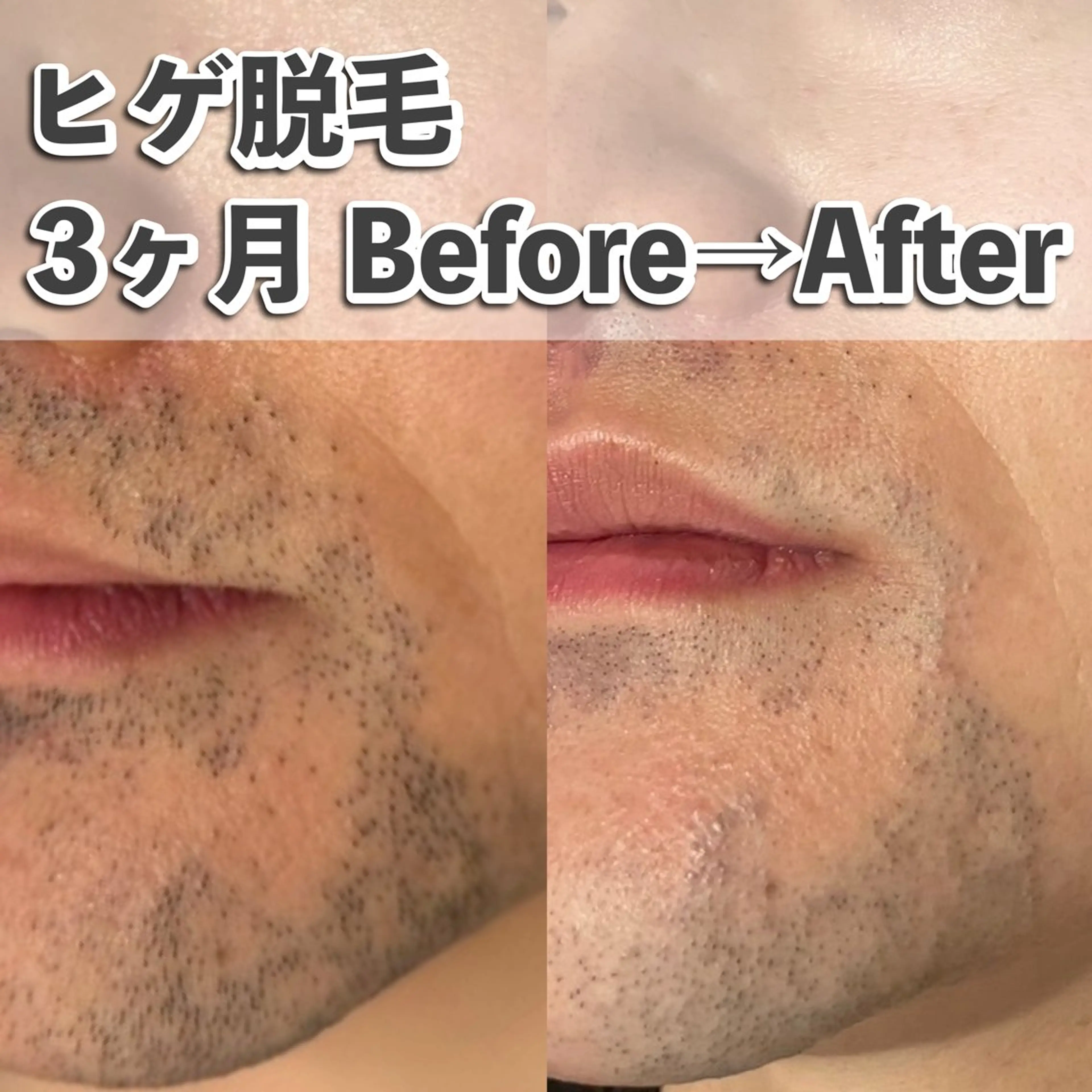 ヒゲ脱毛の写真
