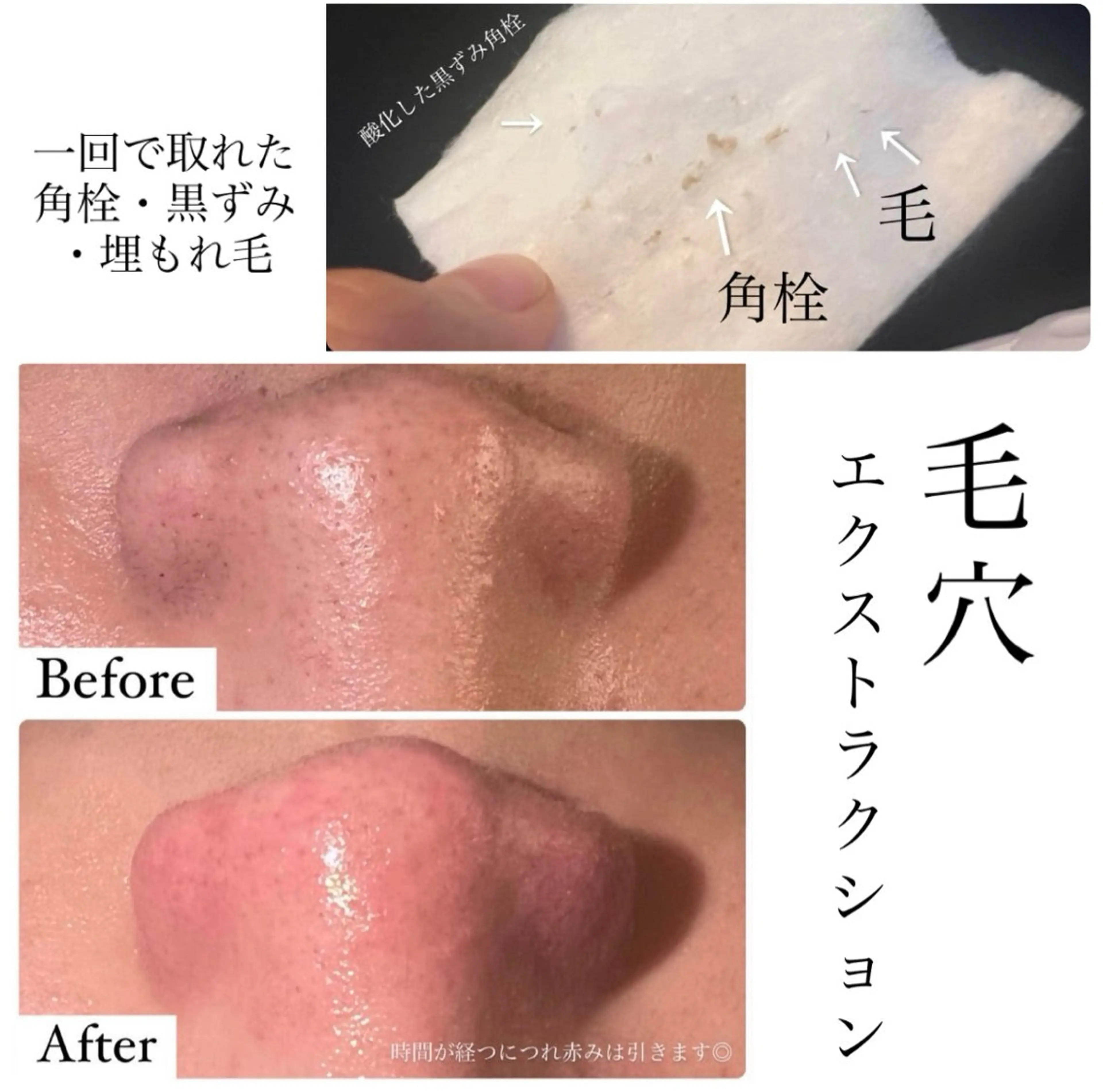【黒ずみ・いちご鼻】毛穴洗浄エクストラクションの写真