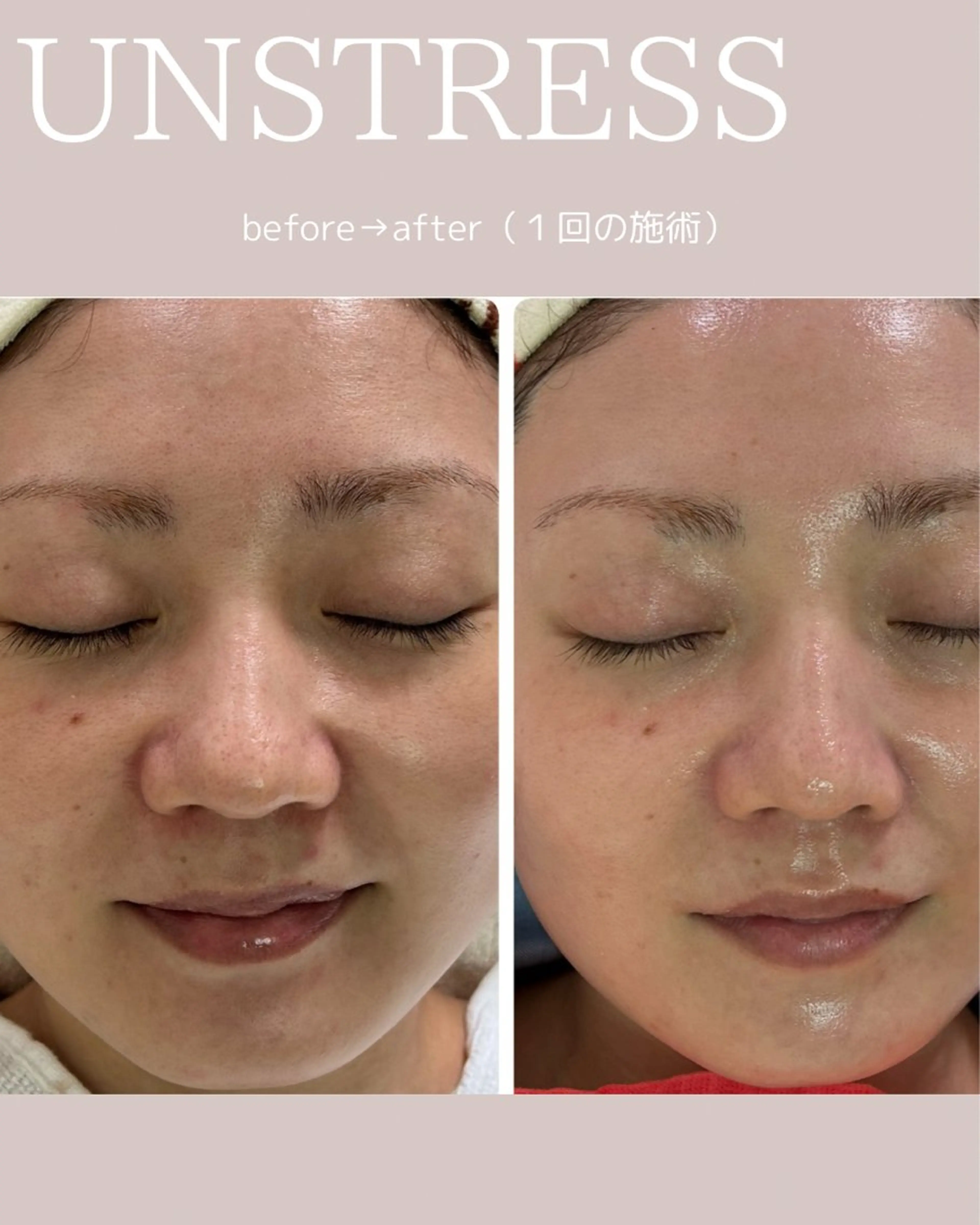 【毛穴•ハーブピーリング】 ニキビ対策サロンétoile クリスティーナ正規取扱店所属・松尾 佳奈のエステ・リラクイメージ