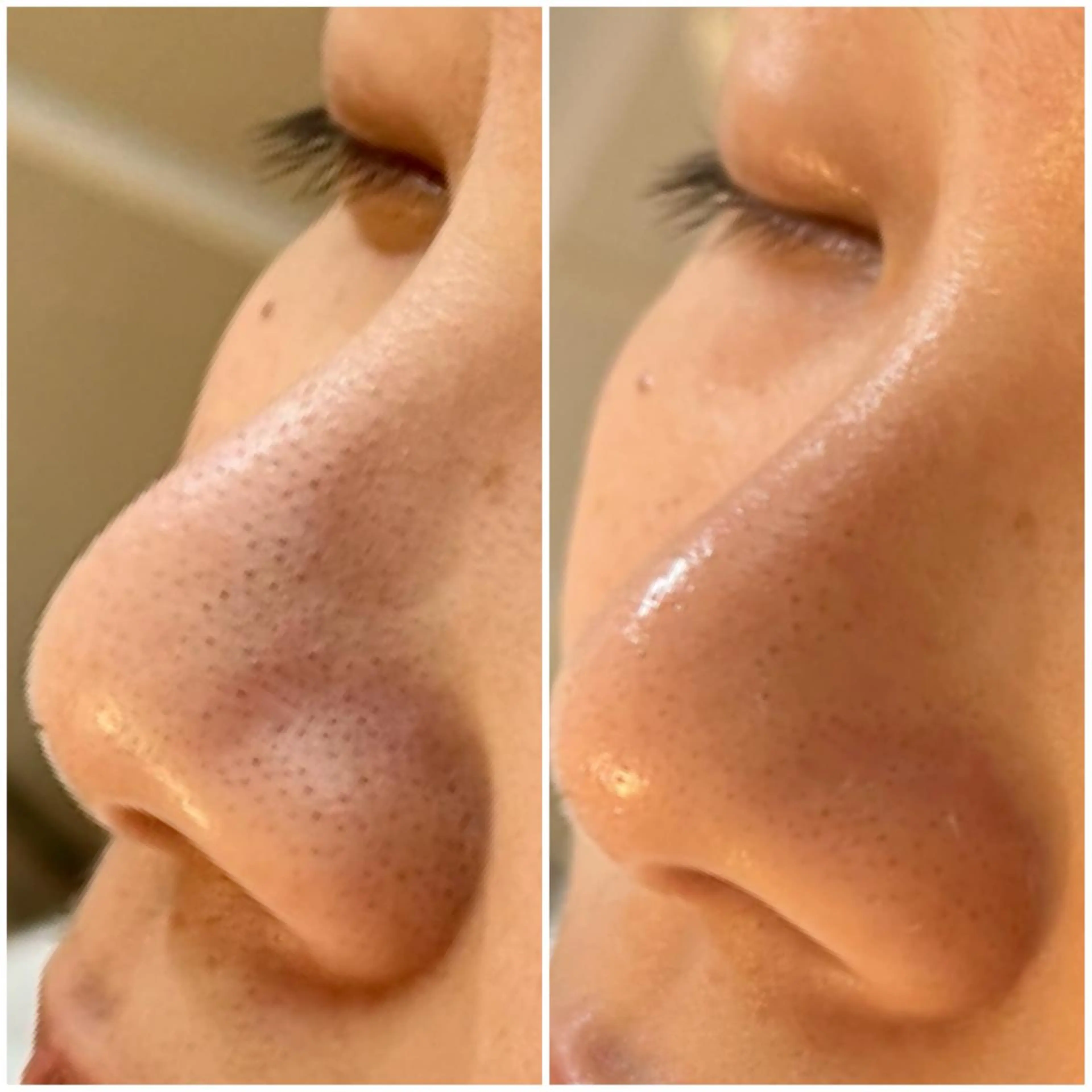 ハーブピーリング /毛穴ケア/脱毛/韓国ツヤ肌専門店【HARU.】所属・韓国ツヤ肌ピーリング ハーブ脱毛HARU.のエステ・リラクイメージ