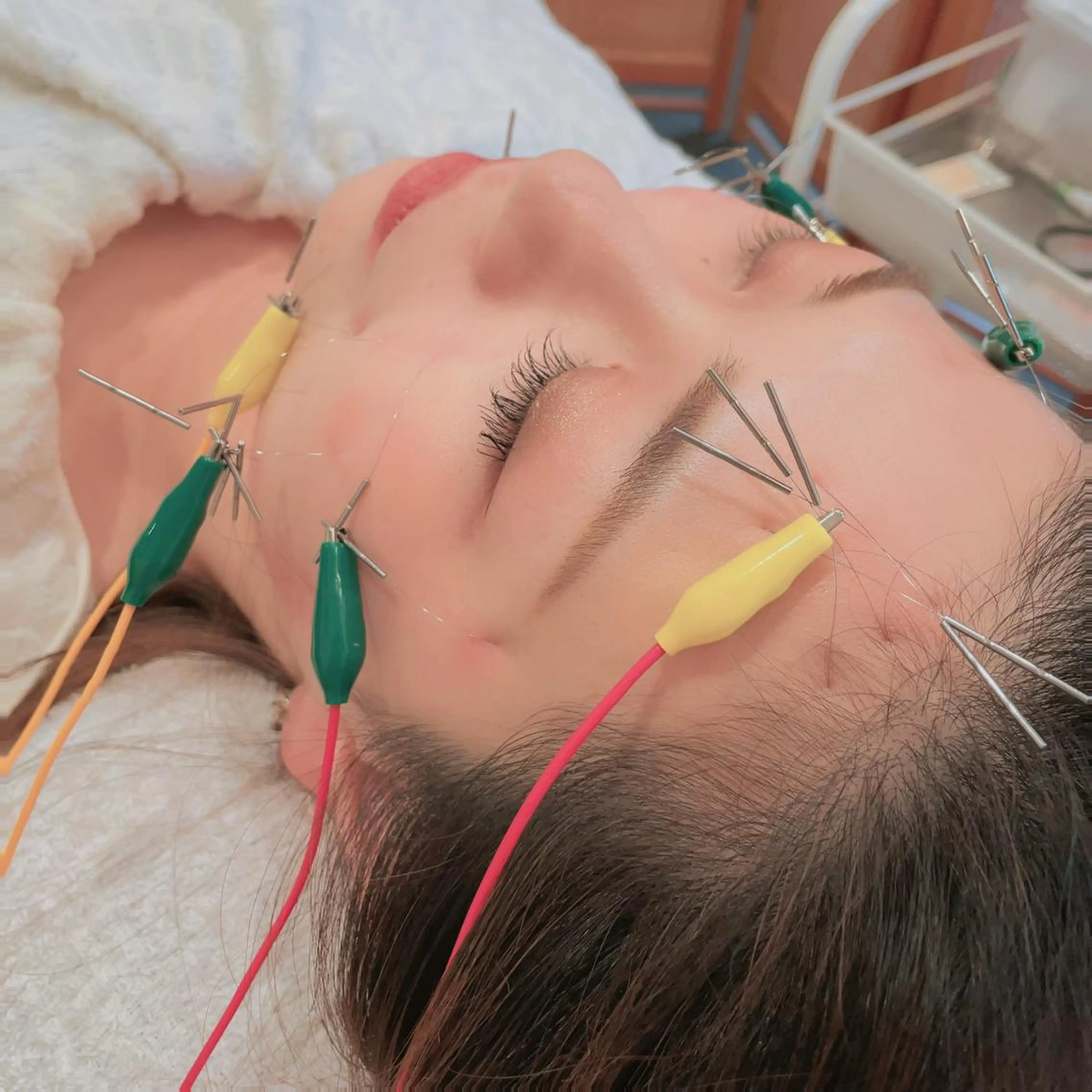 【minimo限定❤✨】ハリグリッター　微弱電流を流す美容鍼の写真