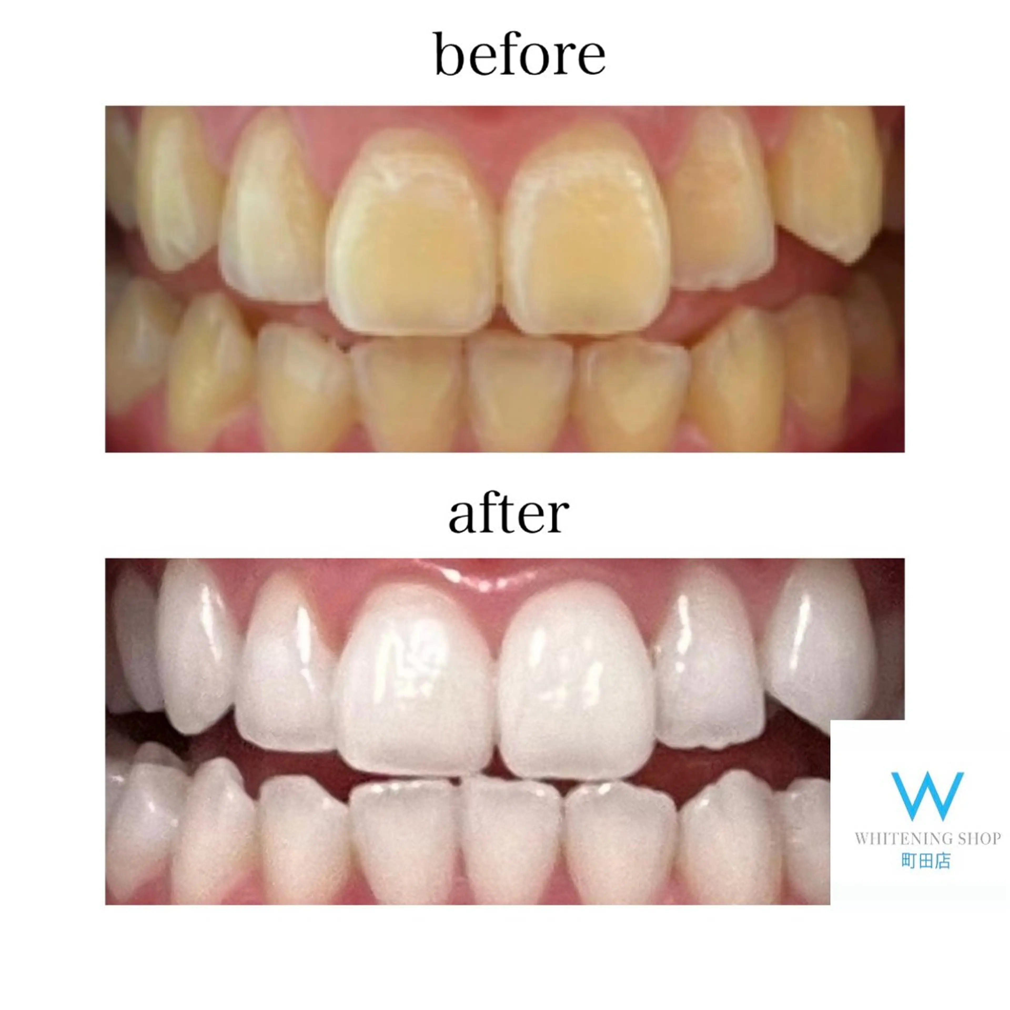 メンズ キッズ その他 ホワイトニングショップ町田店所属・ホワイトニング ショップ町田店のその他イメージ