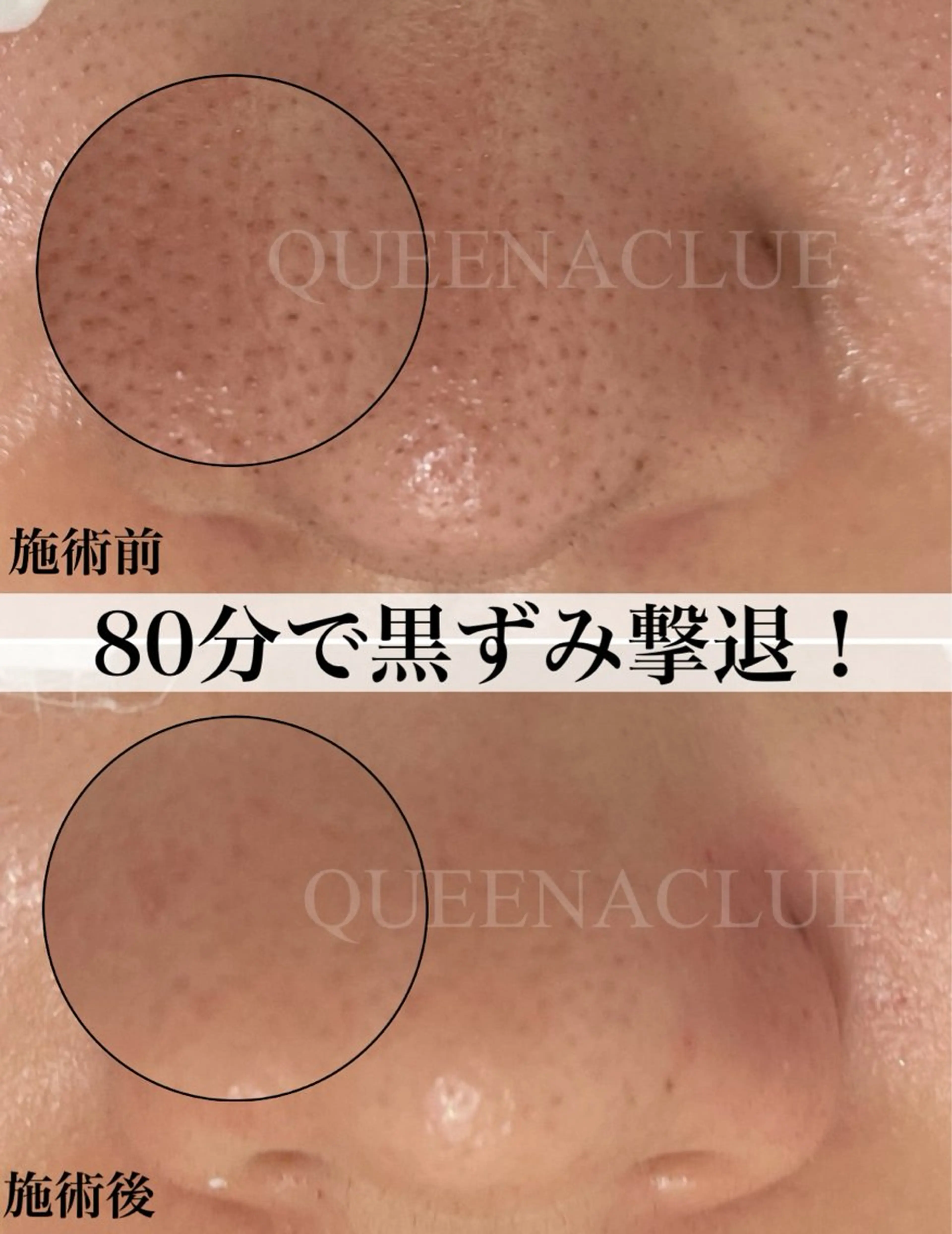 【12月10日12時30分15時限定】毛穴改善ケア¥8800長年のいちご鼻から卒業/毛穴のザラつき/黒ずみ/毛穴の開きの写真