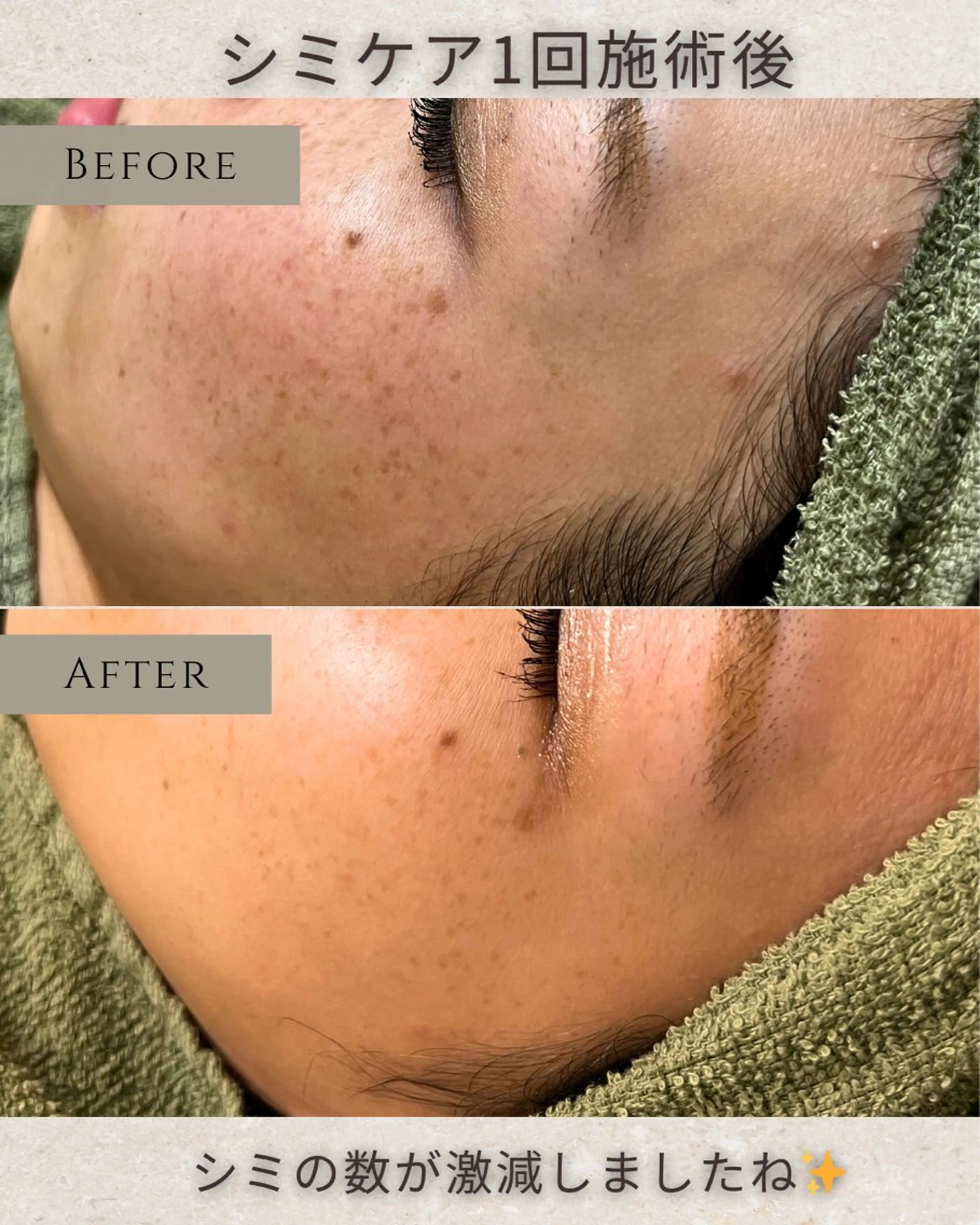 エステ シミ毛穴|眉Wax THE  flowのエステ・リラクイメージ