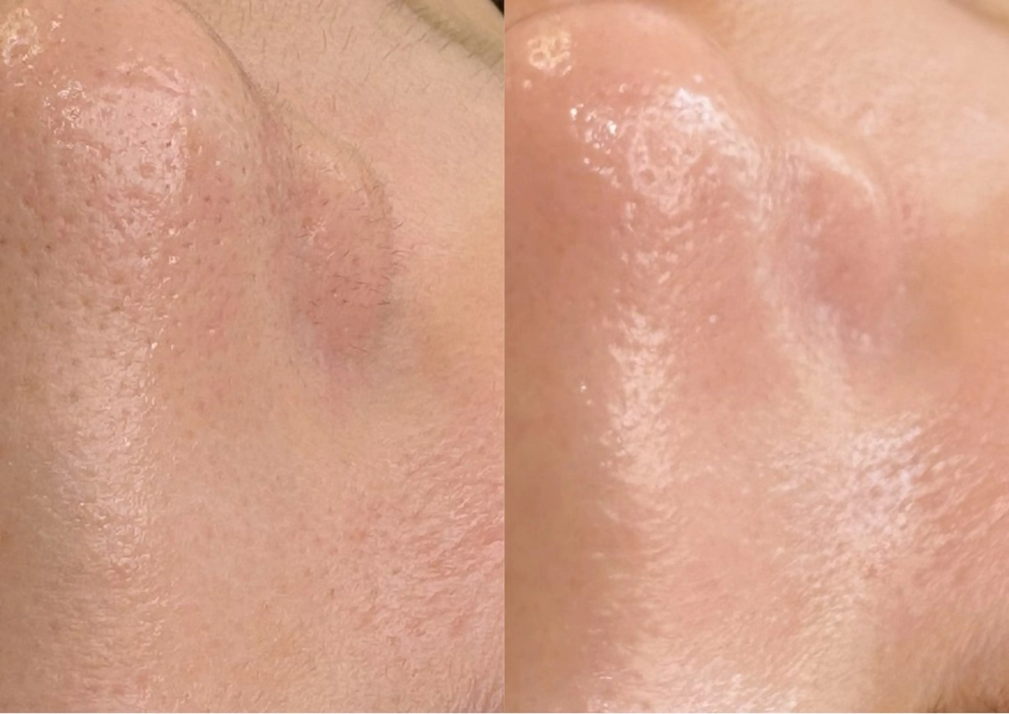 ＜ファンデいらずのツヤ肌へ＞美白＆保湿フェイシャルWAX ¥10,000→¥4,400の写真