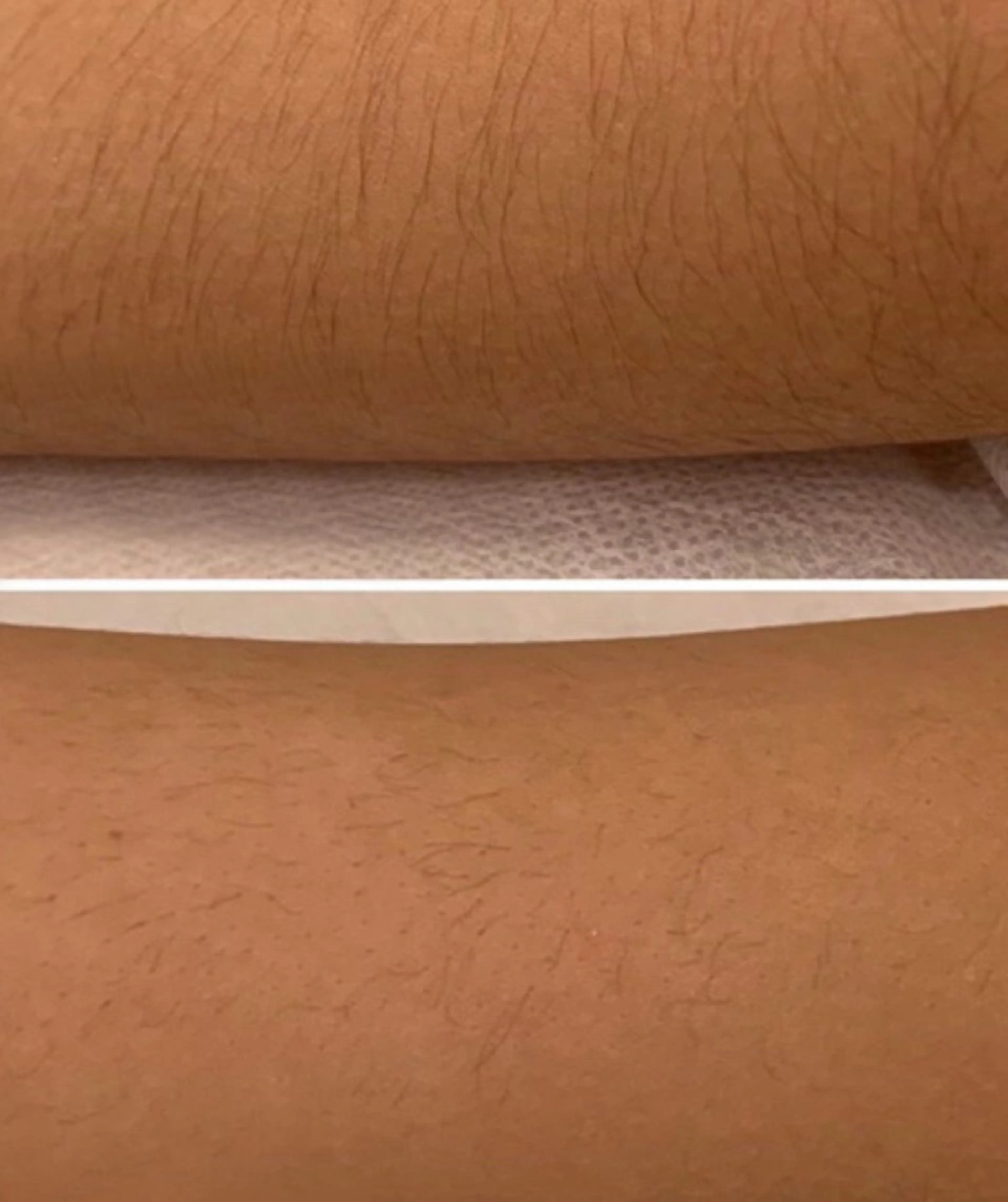 ジュニア脱毛(小、中学生)腕上下+脚上下の写真