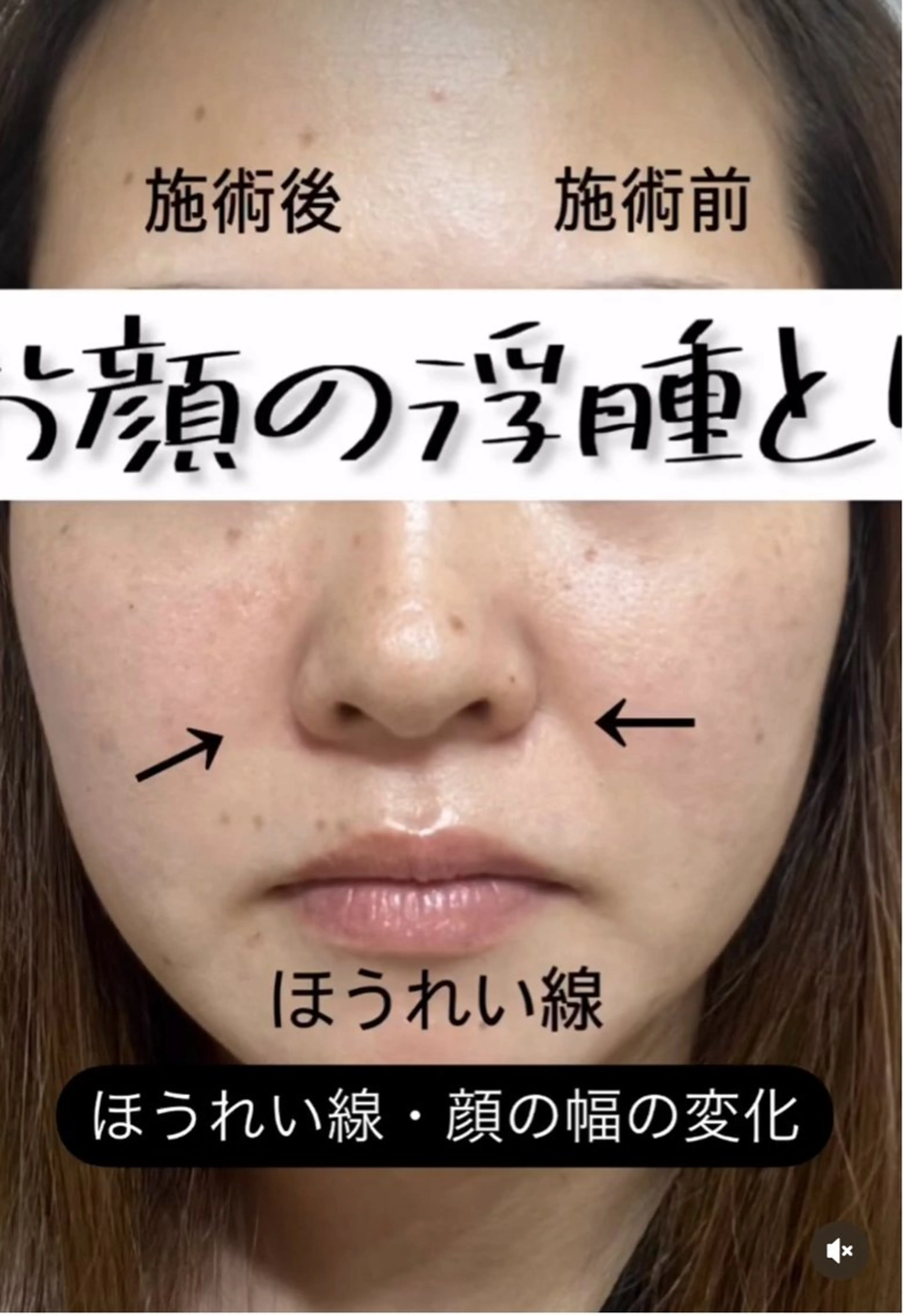 【浮腫・フェイスラインすっきり】顔　ラジオ波　30分の写真