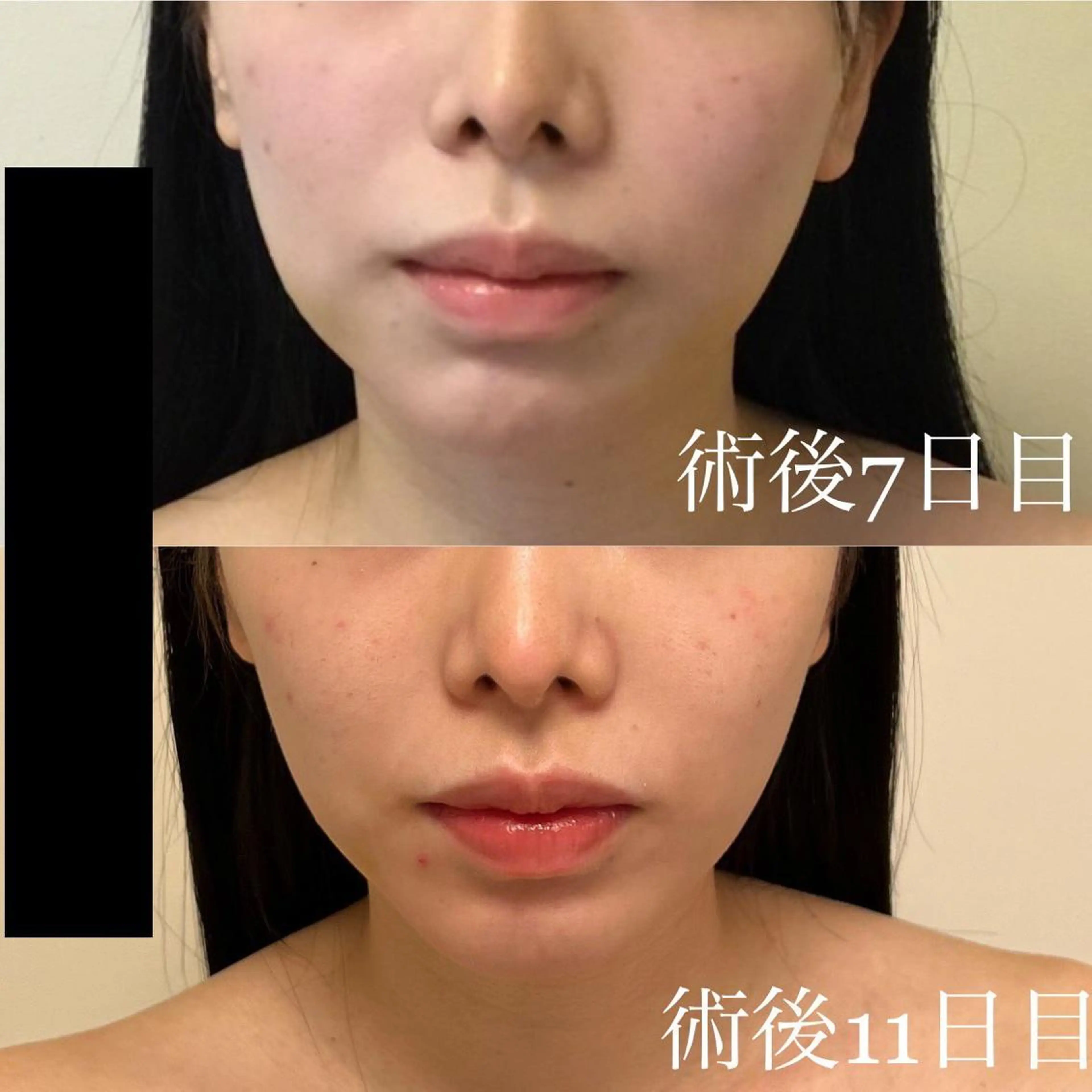 WOM SALON所属・MIKU【美容整形ダ ウンタイムケア銀座】のエステ・リラクイメージ