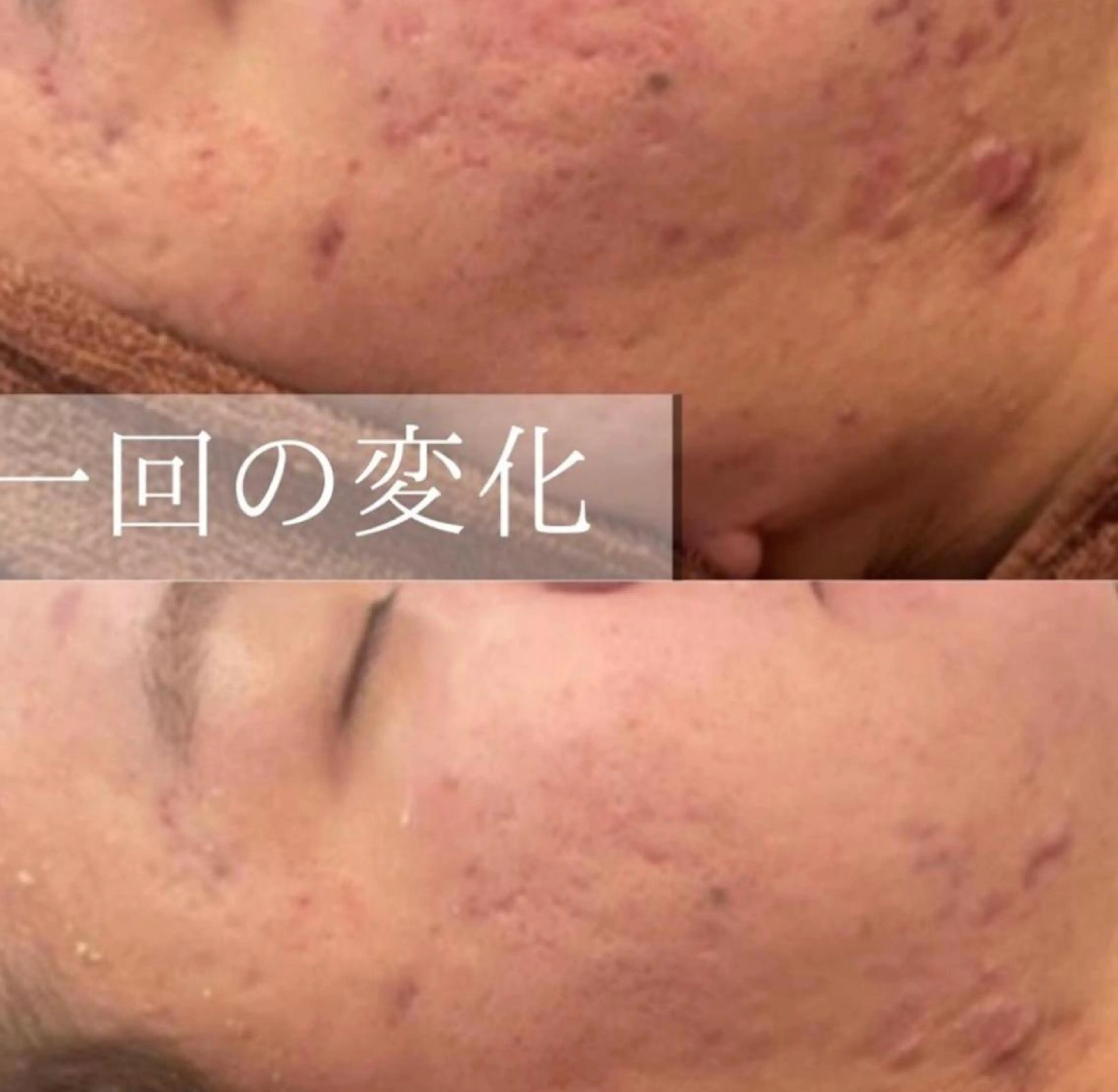 ニキビ特化型エステ 🍓最短で肌質改善のエステ・リラクイメージ