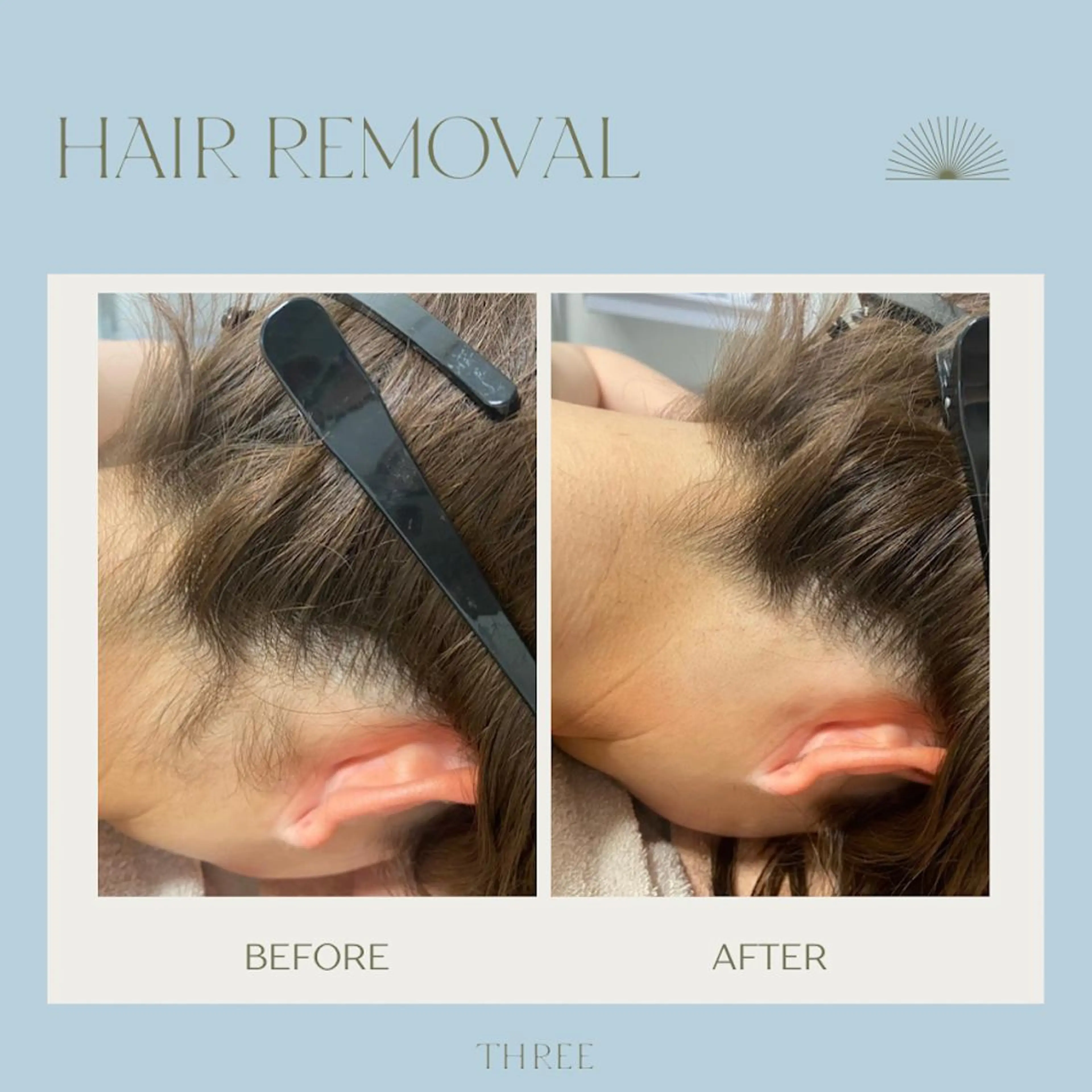 キッズ メンズ 学生（メンズ向け） 脱毛 福留 千春のエステ・リラクイメージ