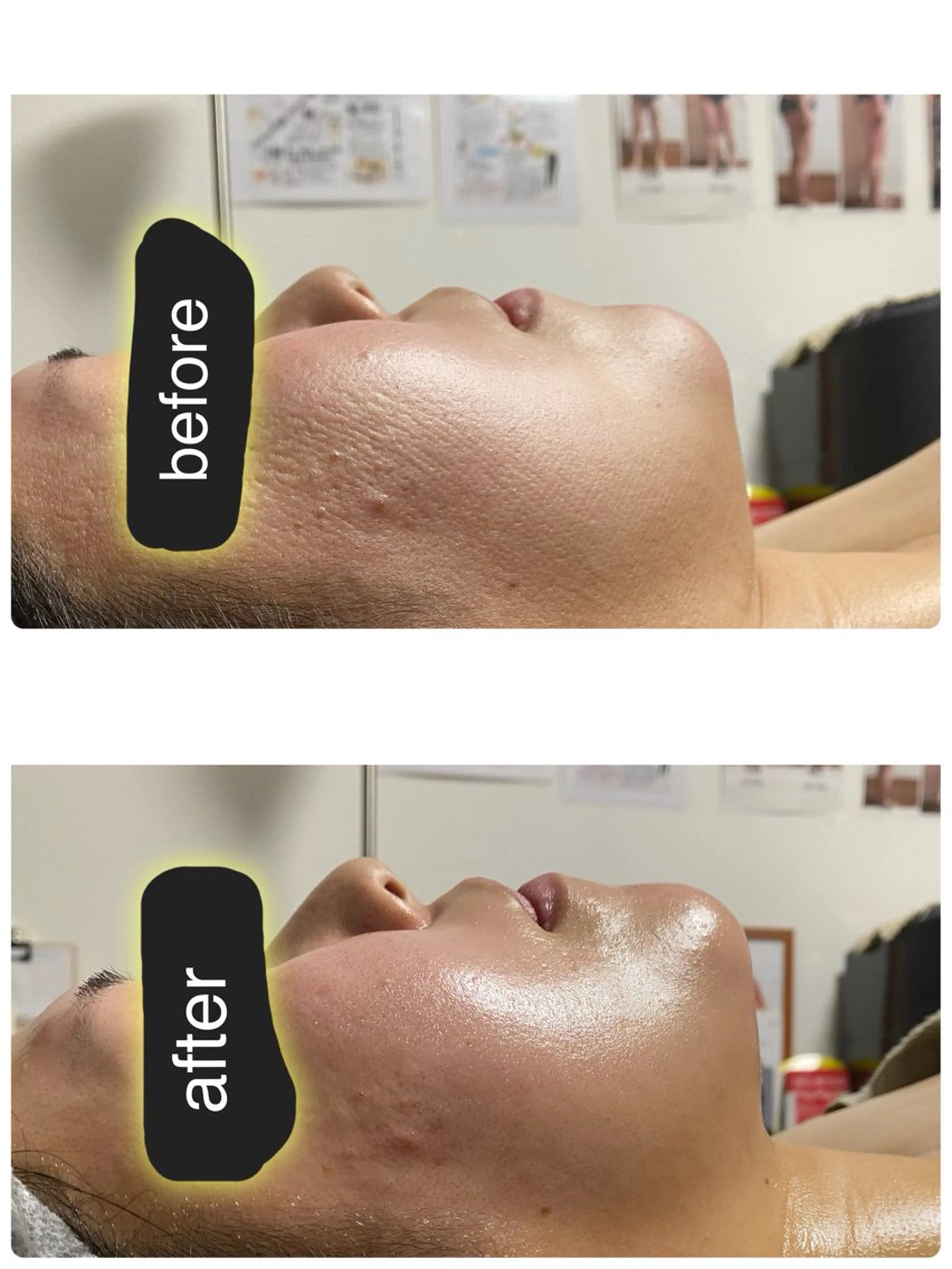 ZERO フェイシャル（コルギ）の写真