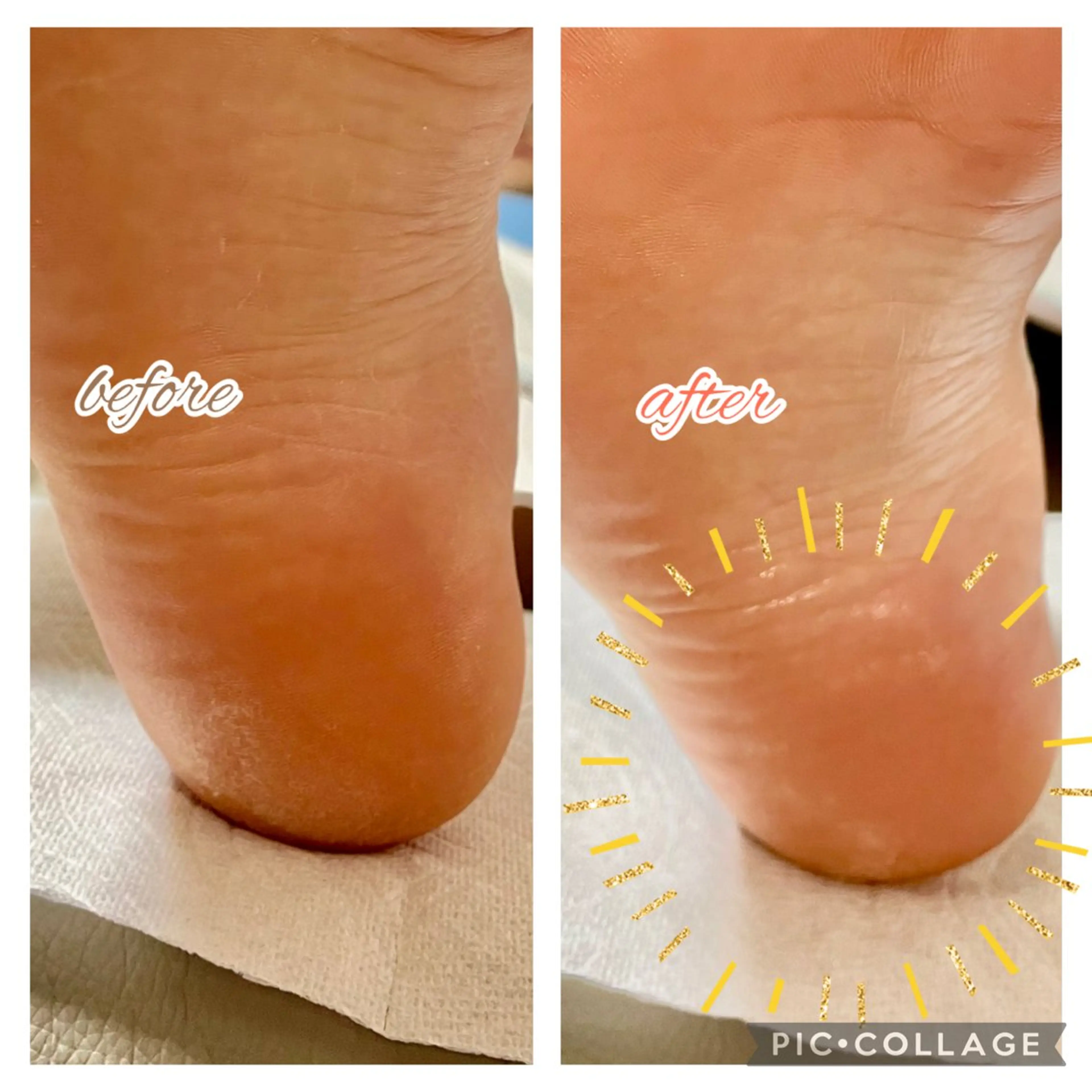 かかとケアの写真