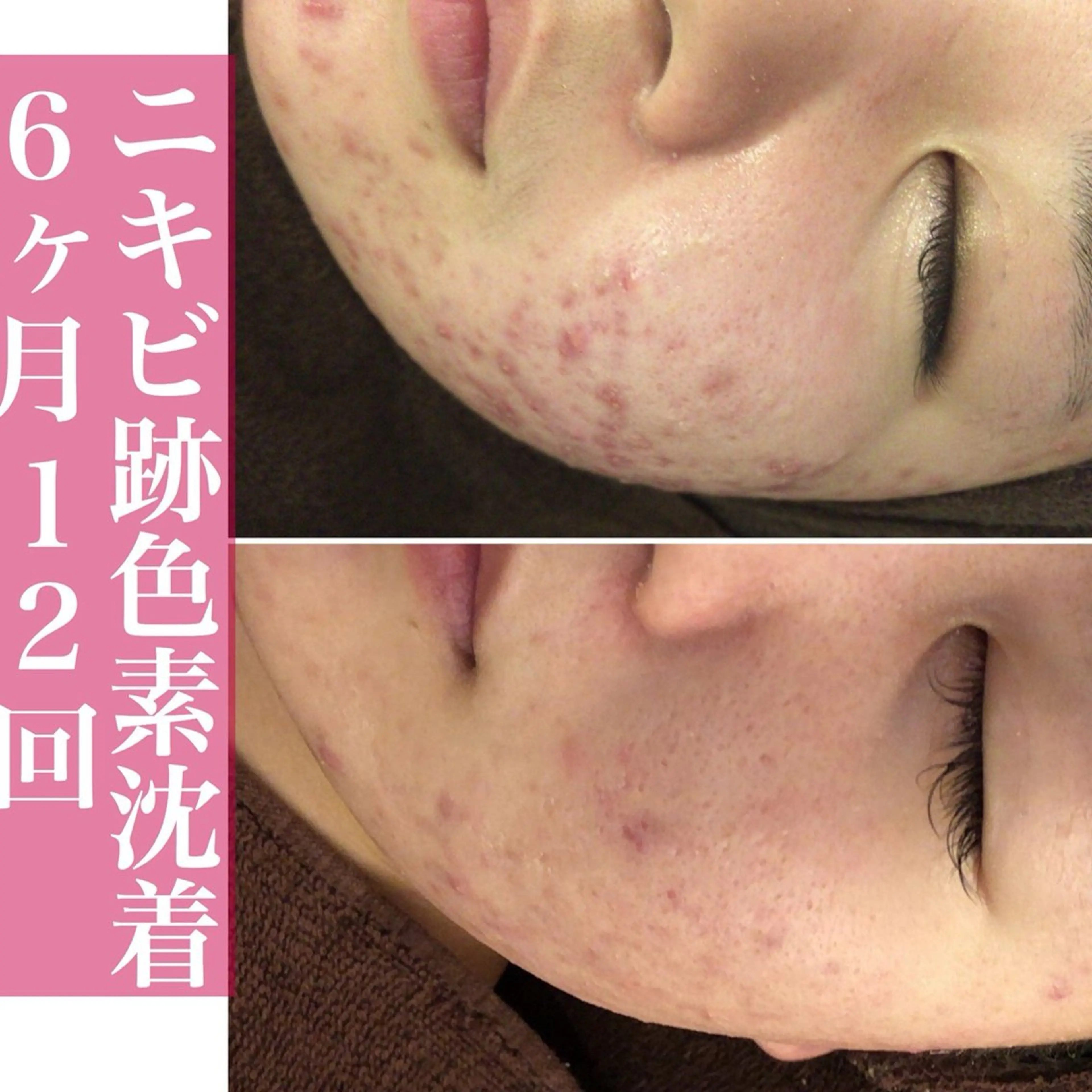 学生ニキビ改善🍀 優しい肌質改善のエステ・リラクイメージ