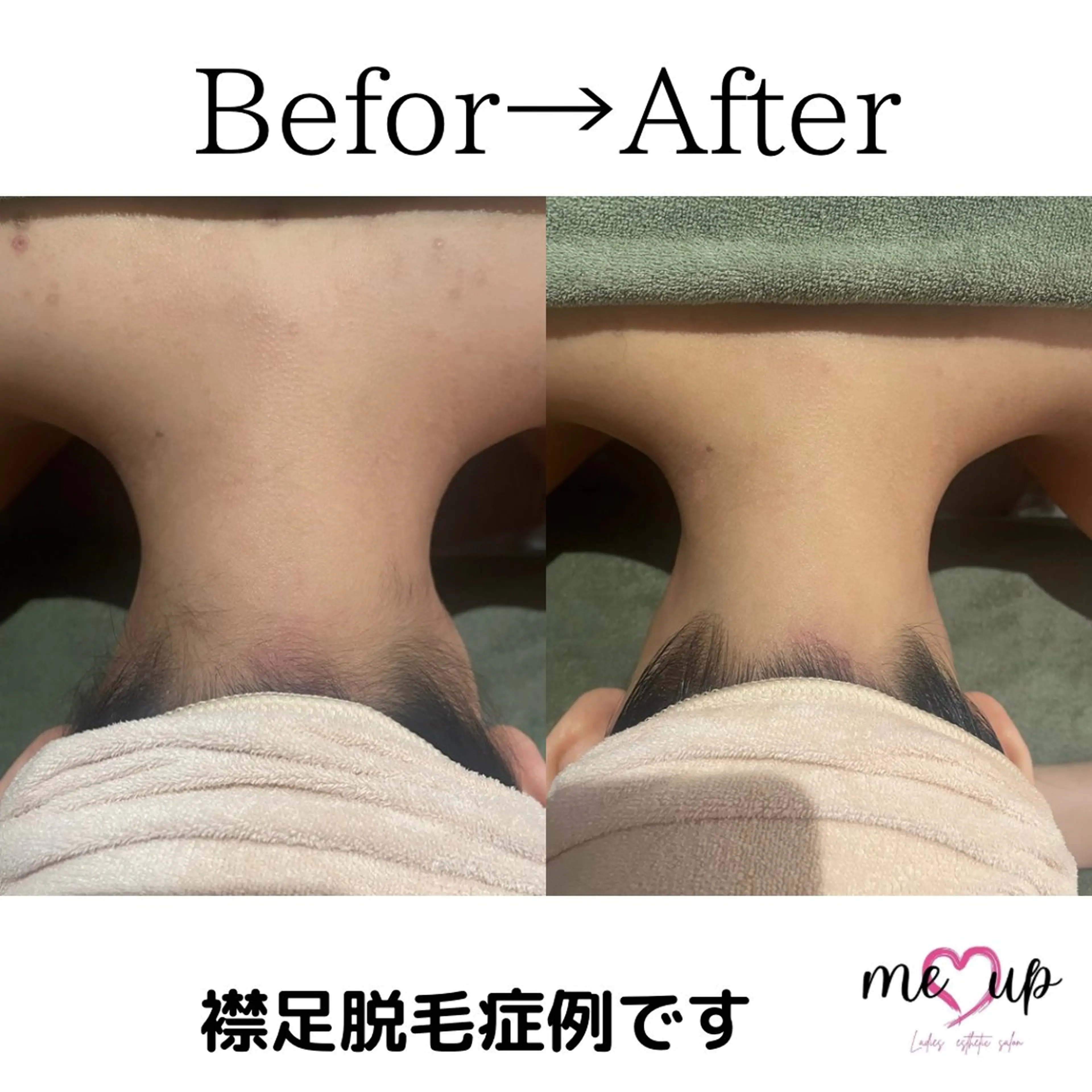 Meupニキビ専門店 背中/ハーブ/肌管理のその他イメージ