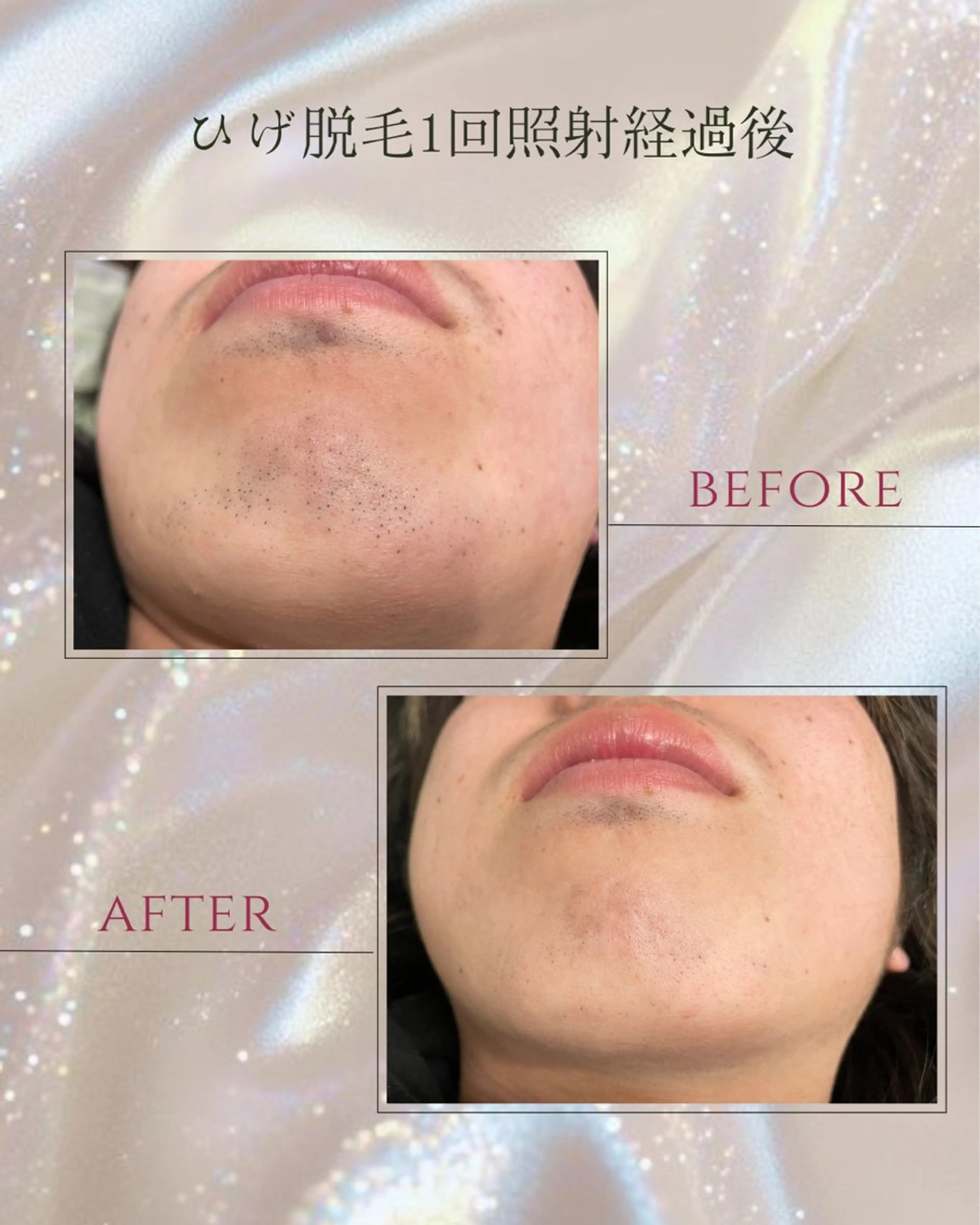 脱毛 DISINI  SPA所属・DISINISPA 脱毛/フェイシャルのエステ・リラクイメージ