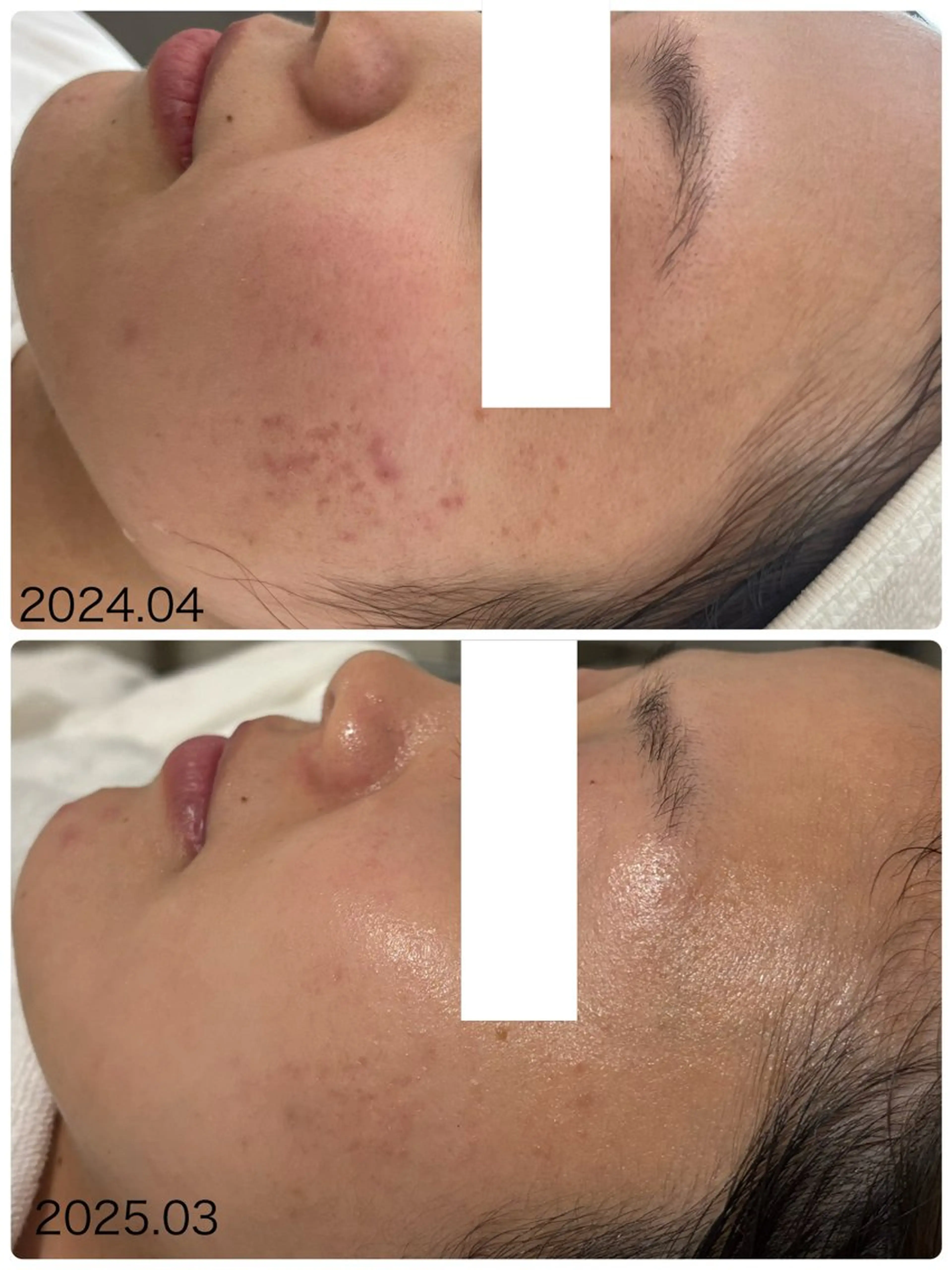 エステ NARIS BEAUTY STATION　デ・アイム あべのルシアス所属・ニキビ跡/毛穴/ 肌質改善/北村ももこのエステ・リラクイメージ