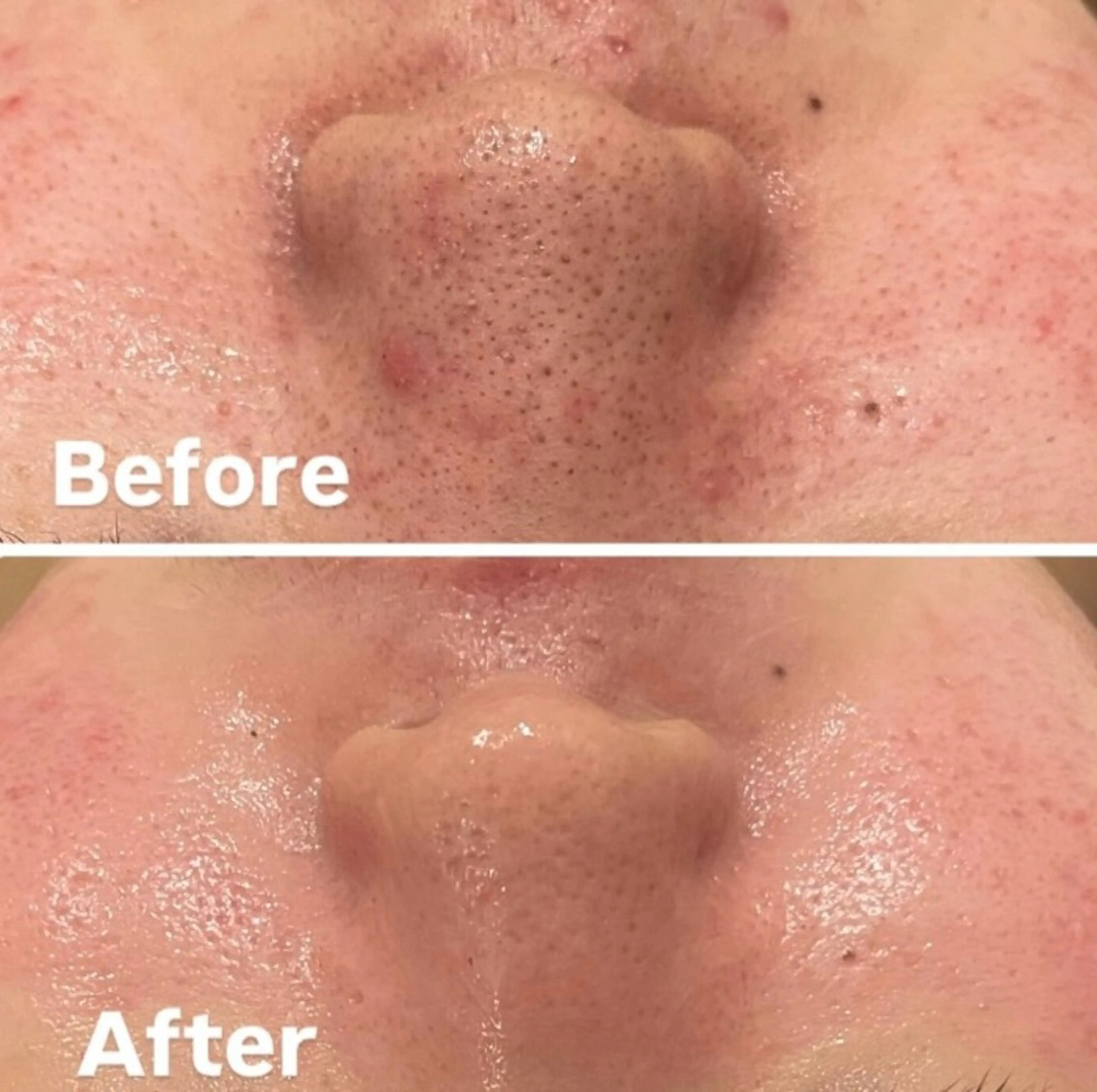 【毛穴黒ずみ】毛穴の詰まりを瞬時に解放・クリアな肌の第一歩へ¥5000→¥4500の写真