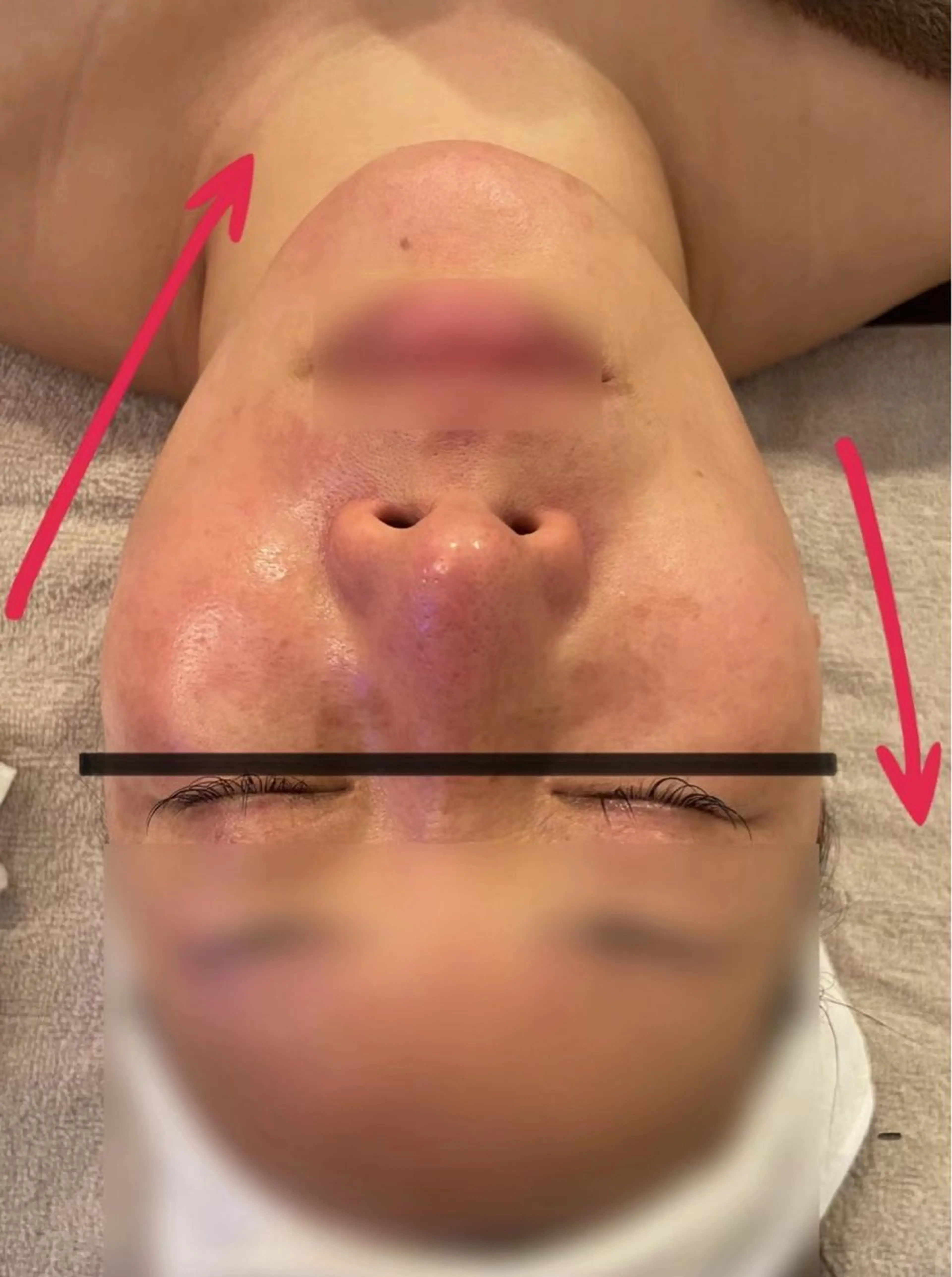 【効果MAX】小顔筋膜リリース×小顔ハイパーナイフ　60分￥7980の写真