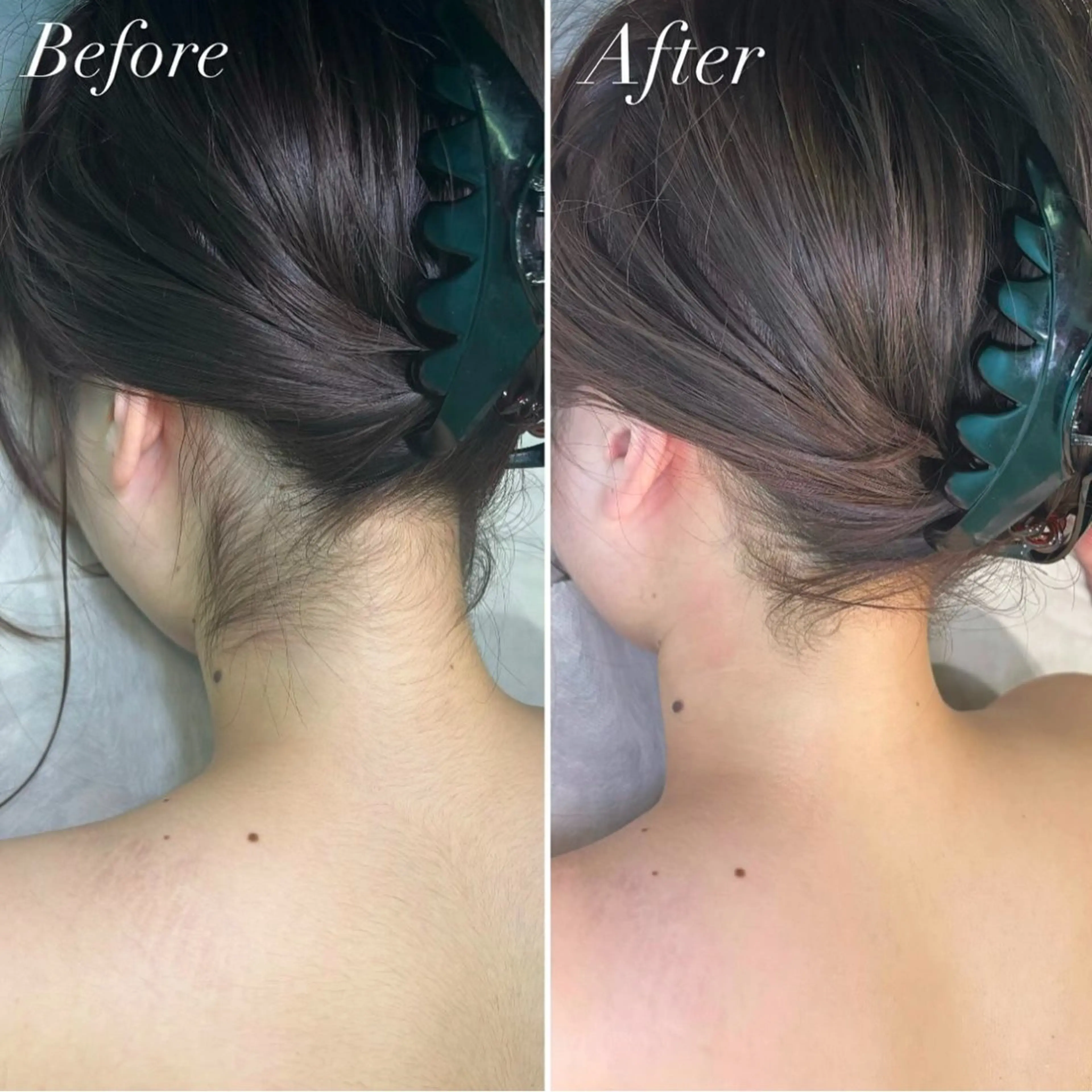 【シェービング】本格うなじシェービング♡ 大事な日の前に✨整ったうなじ✨の写真