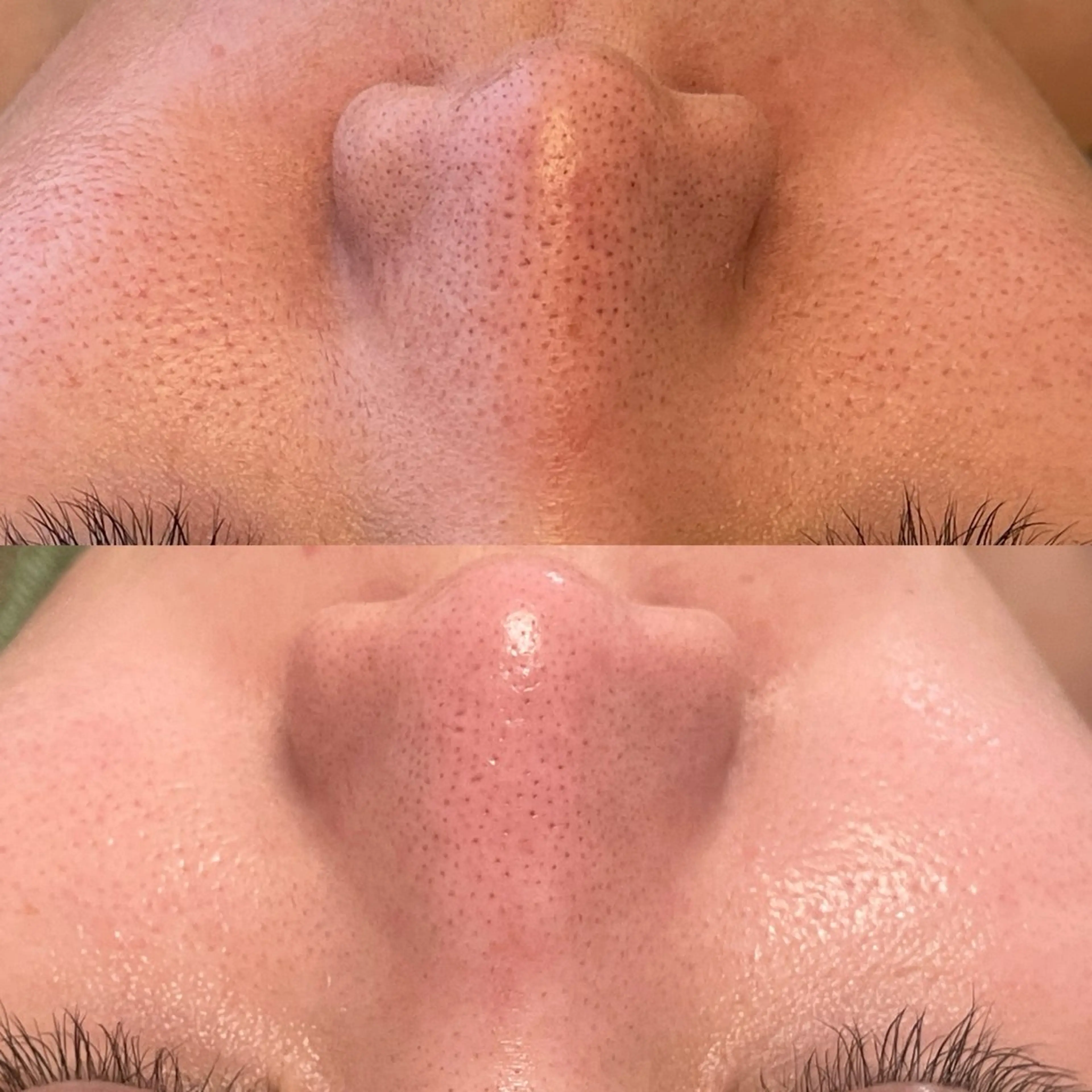 エステ リラク ニキビ・毛穴改善 🌿ハーブピーリングのエステ・リラクイメージ