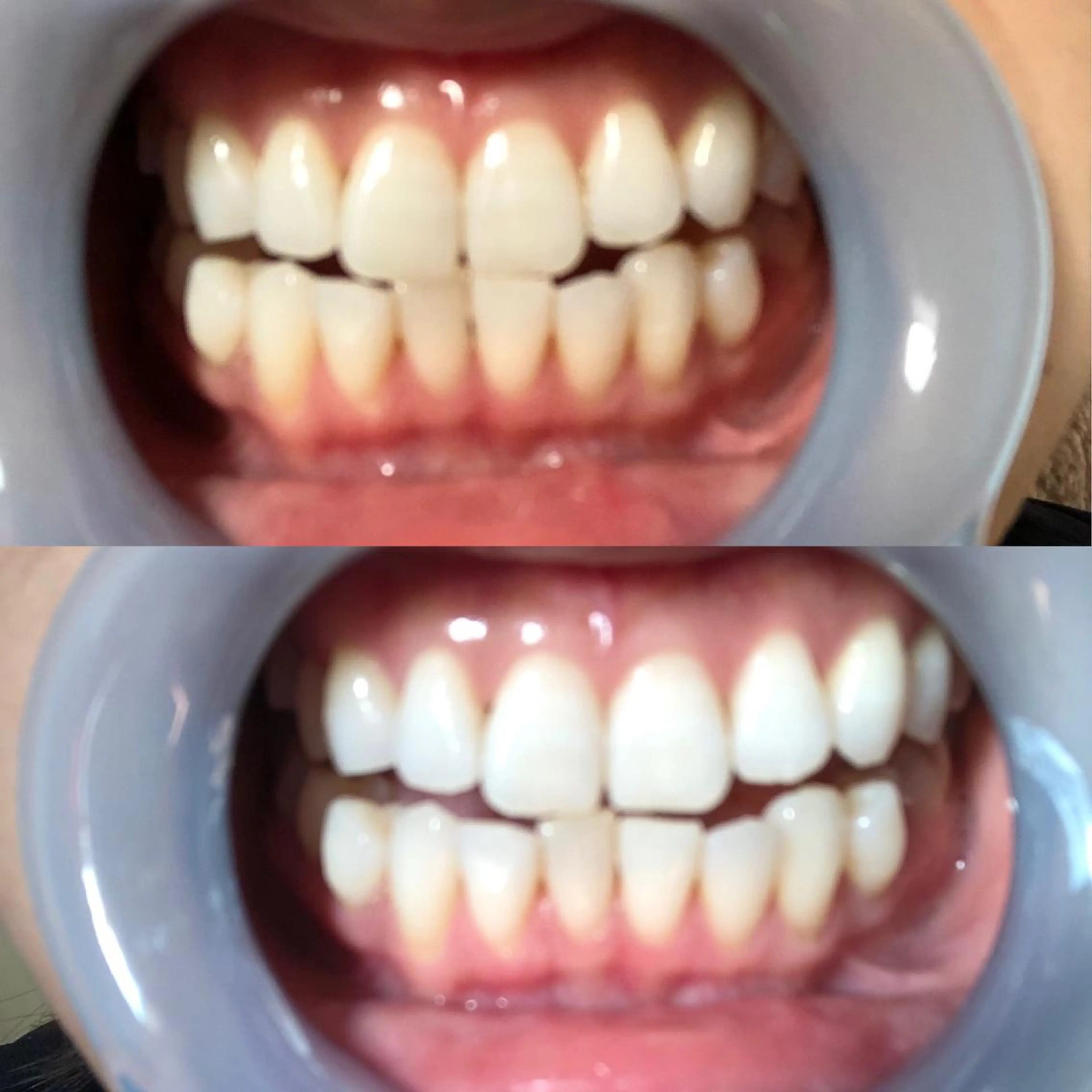 歯のホワイトニング5回通い放題🦷《メンズ可》の写真