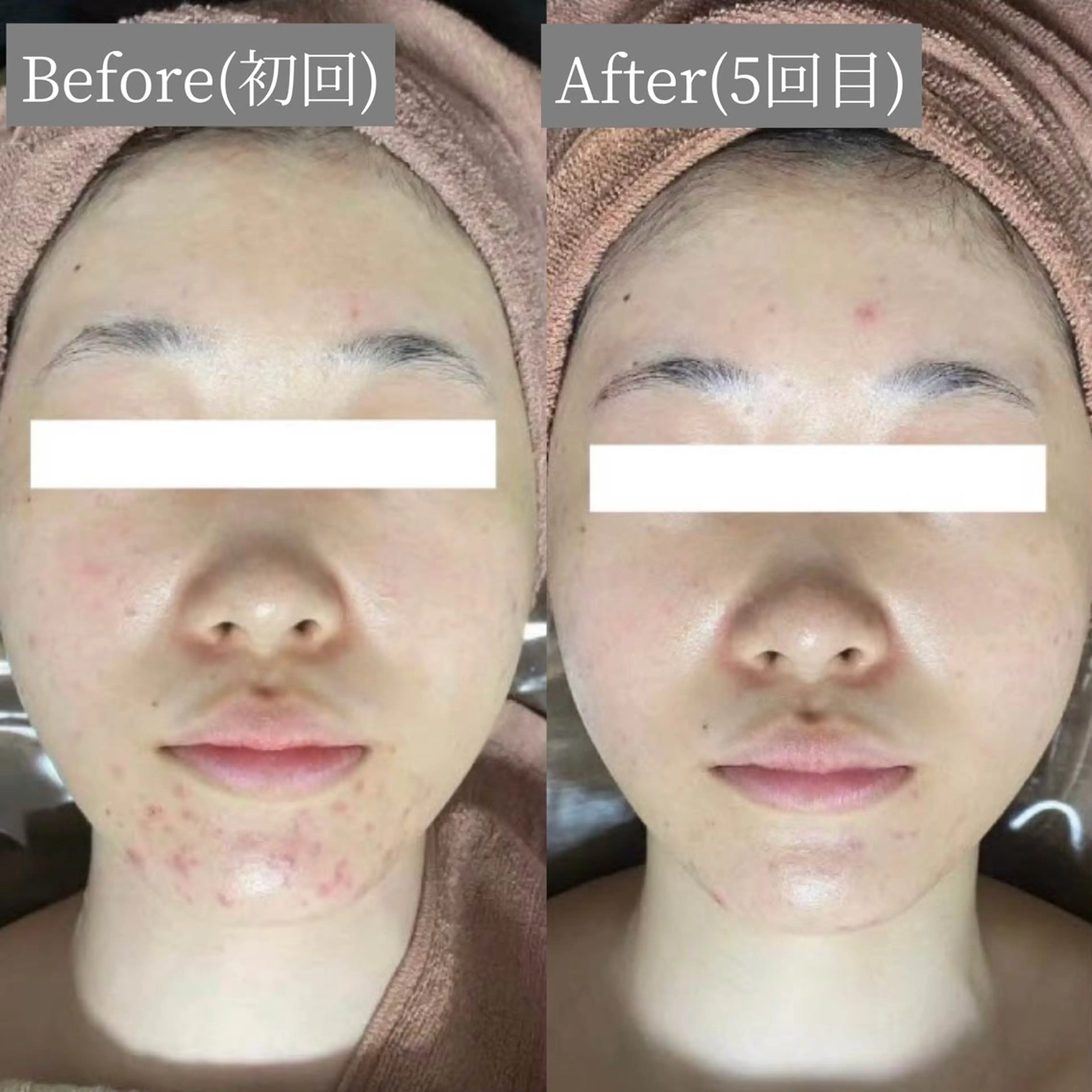 エステ リラク 毛穴・ニキビケア　ハーブピーリング【肌管理専門店】WHITE AQUA鳳店所属・ホワイトアクア 鳳店のエステ・リラクイメージ