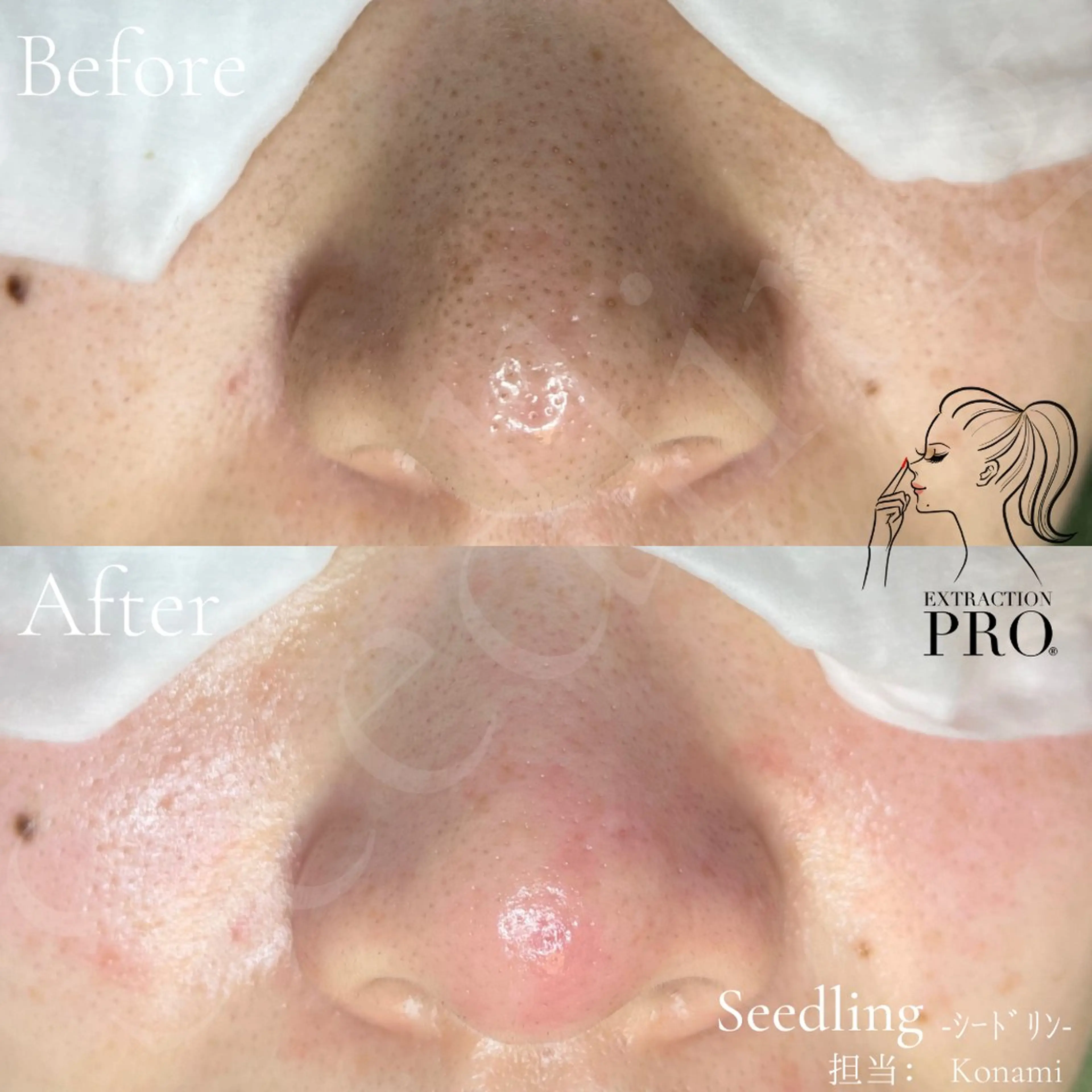 毛穴エクストラクション★いちご鼻を徹底ケア！の写真