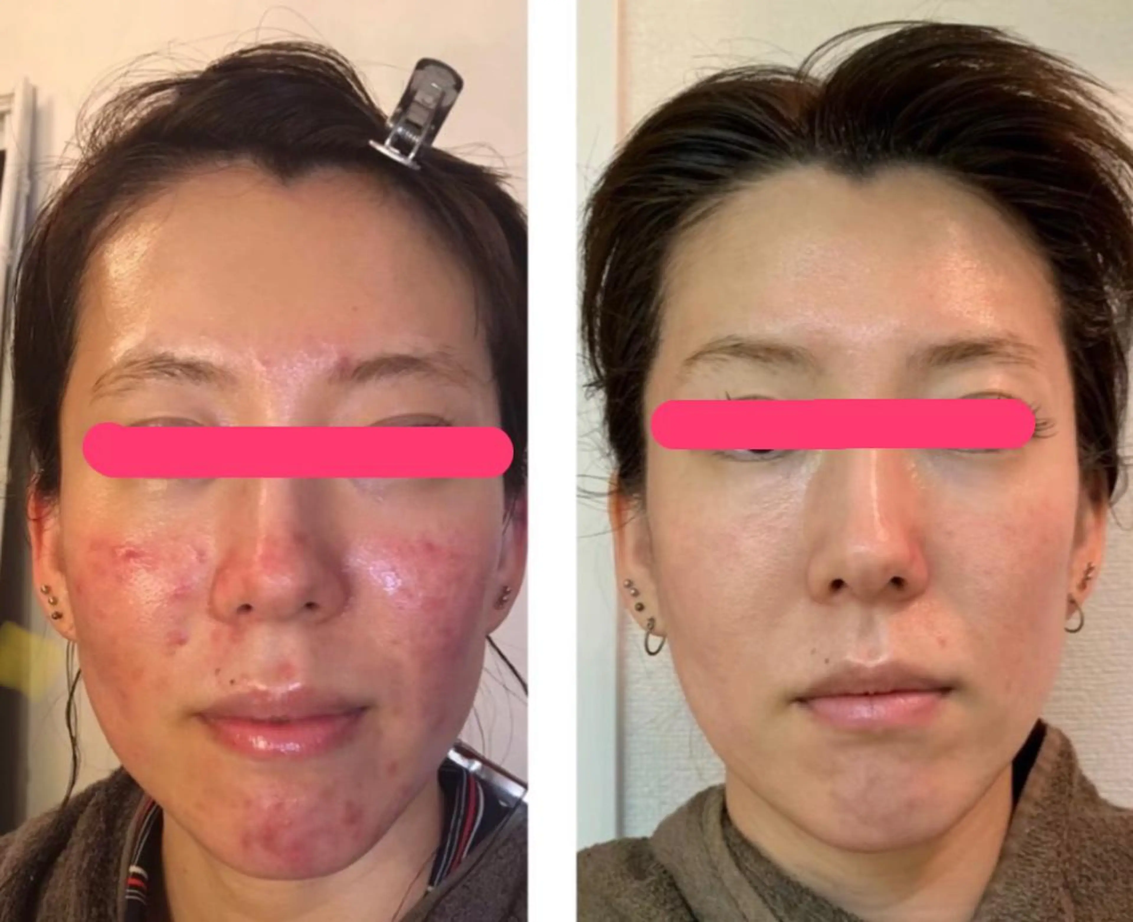 【アクネ改善・予防ケア】フェイシャルコース60分の写真