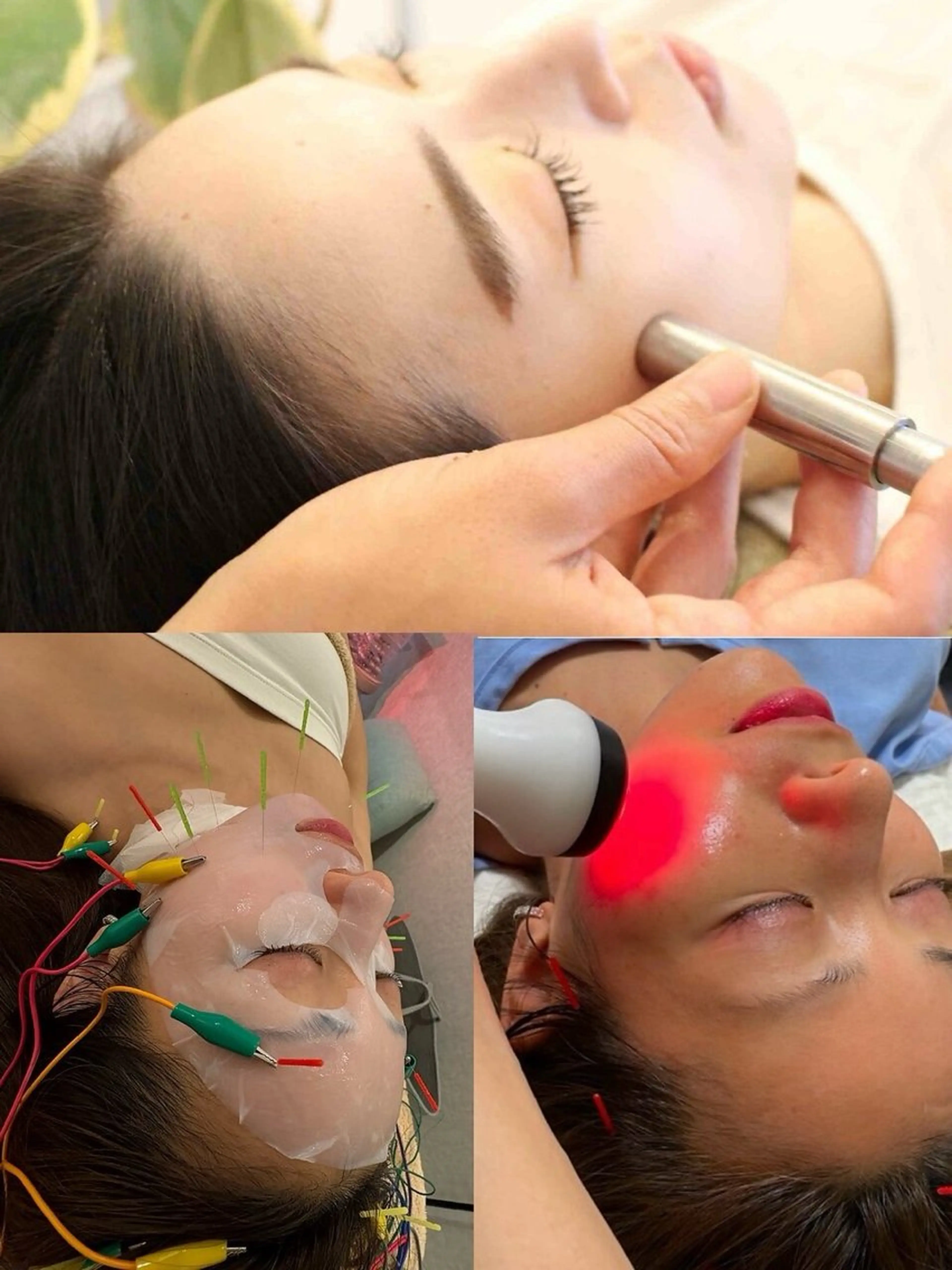 人気急上昇🌟最強セット💎ダーマ鍼＋幹細胞エレポ導入&美容鍼💎お肌数万箇所に穴をあけお肌再生力up!最強美容鍼の写真