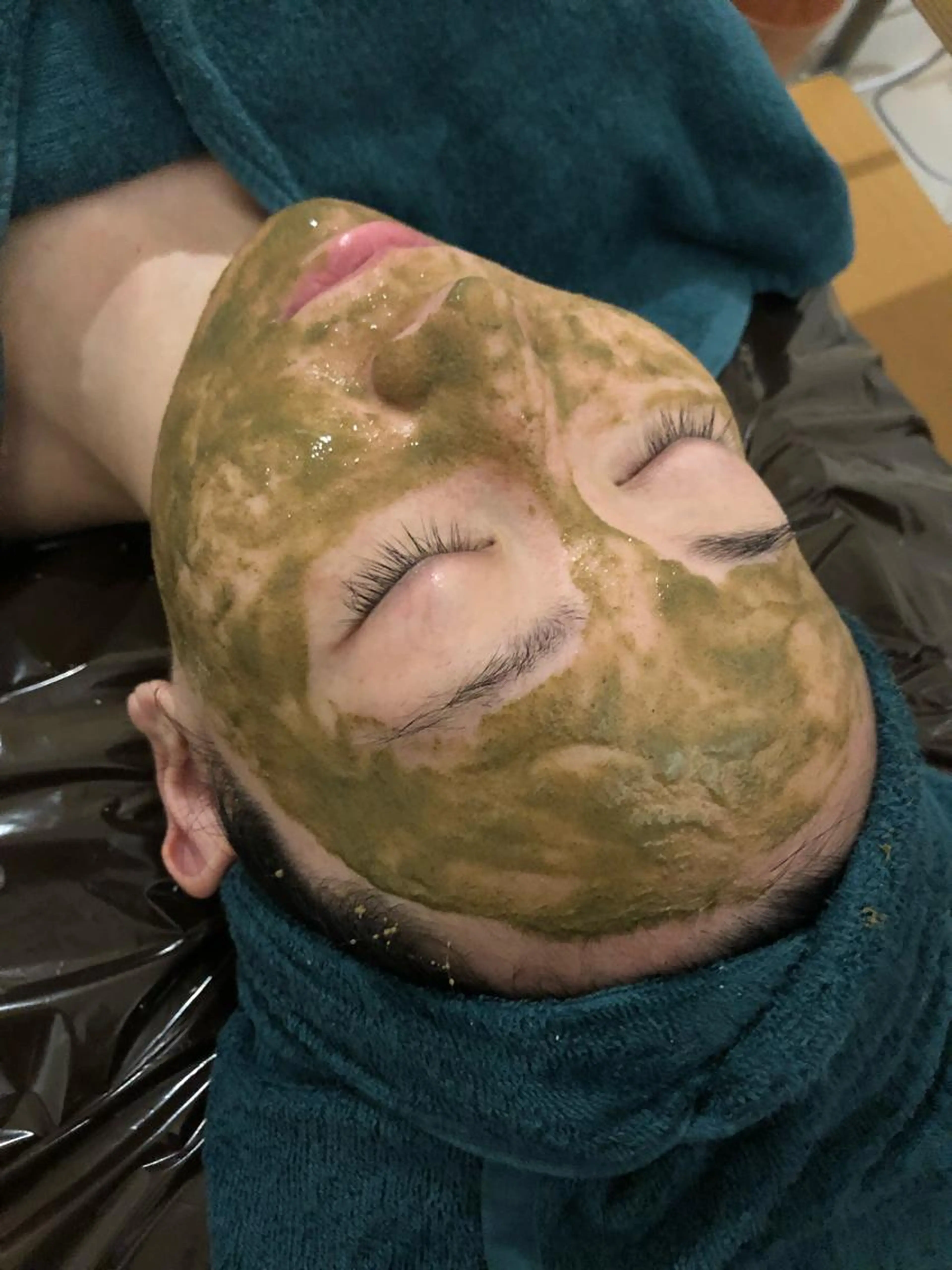 【初回限定】剥離なし！ハーブピーリングの写真