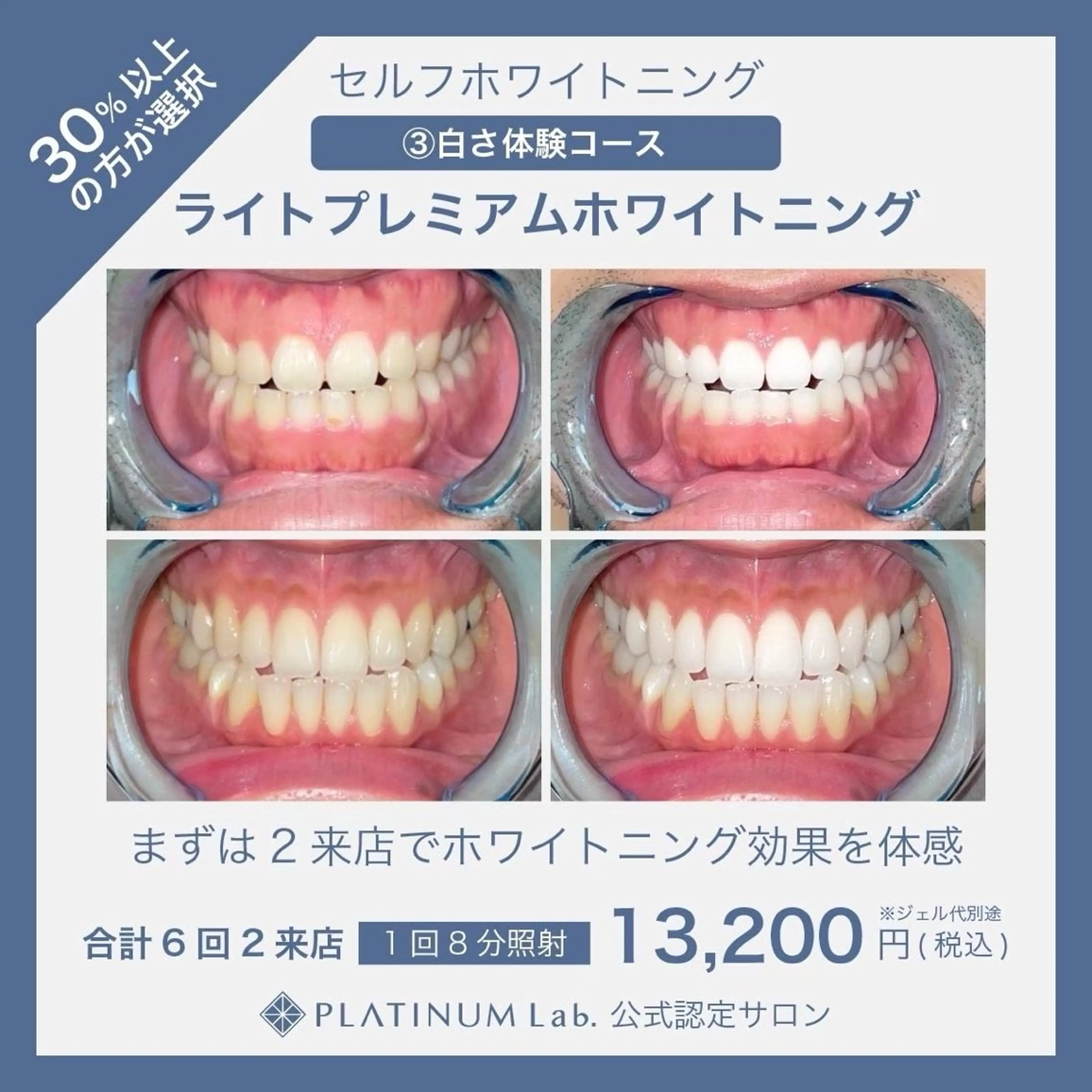 【白さご体験】平均5トーンUP✨️ ライトプレミアムセルフホワイトニング(計50分照射)メンズ歓迎👨の写真